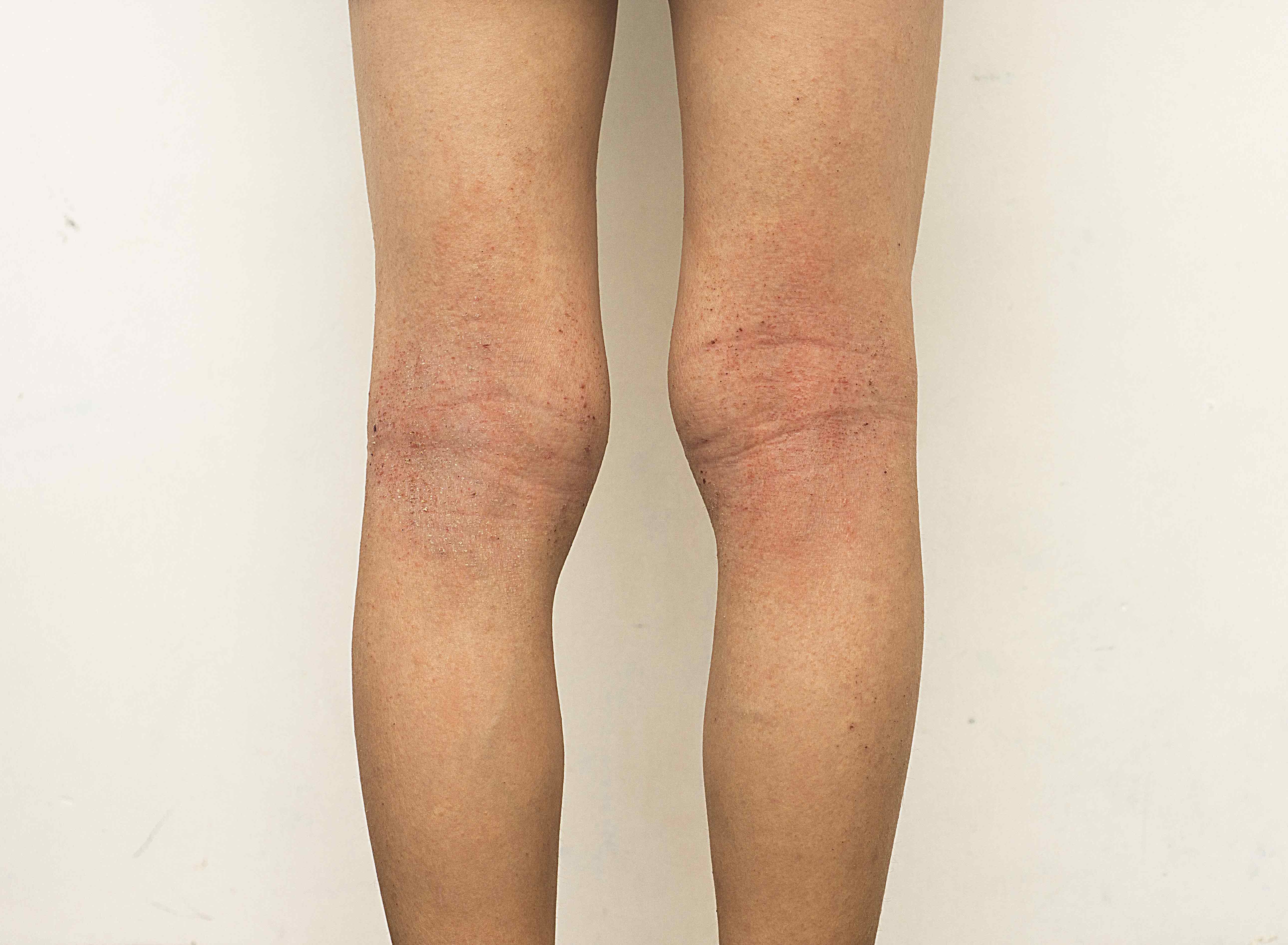 Eczéma des jambes | Fondation Eczéma