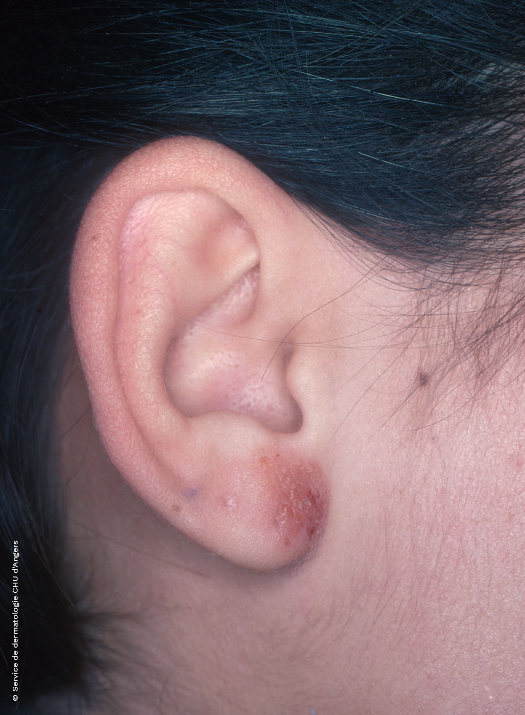 Eczema de contacto en la oreja debido al níquel