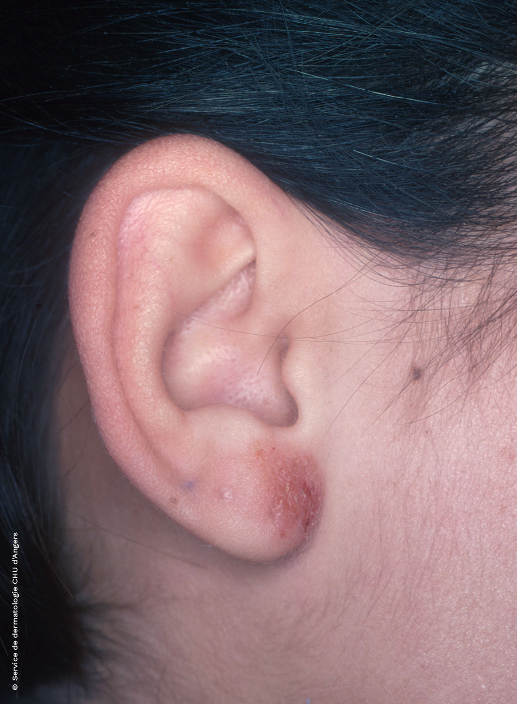 Eczéma des oreilles | Fondation Eczéma