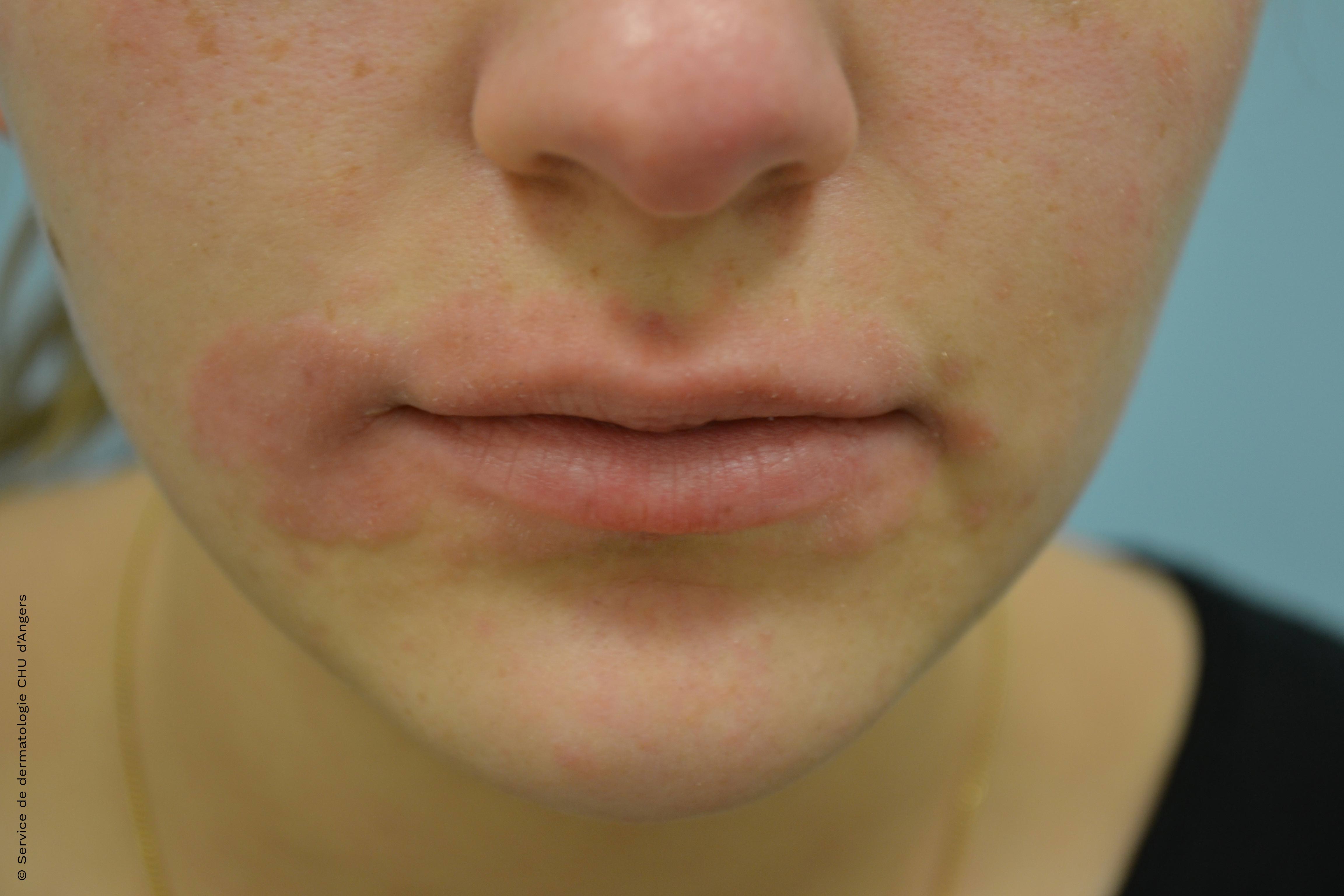 Eczema perioral