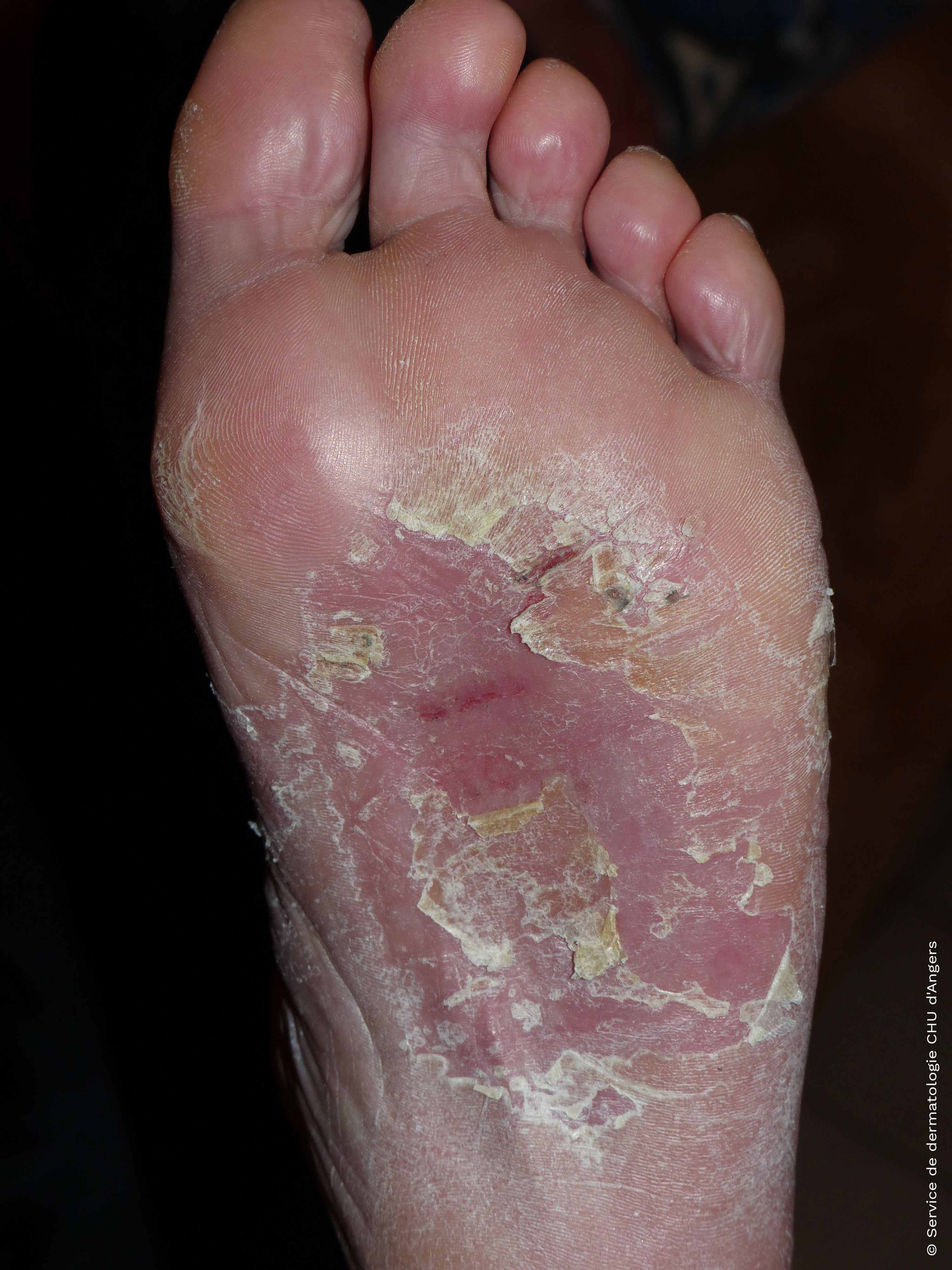 Eczema de contacto en los pies debido a la cola y el cuero de los zapatos