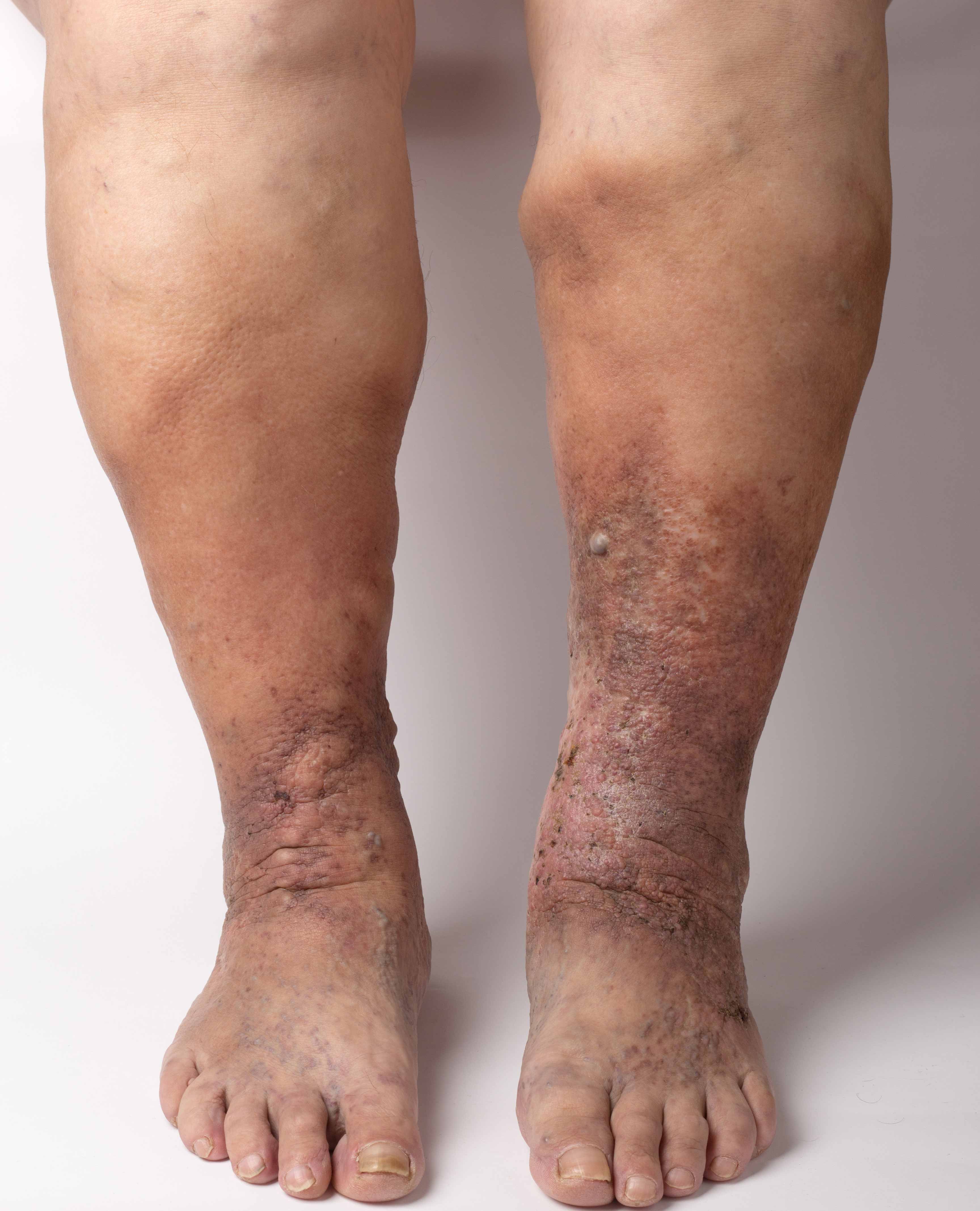 Varicose eczema