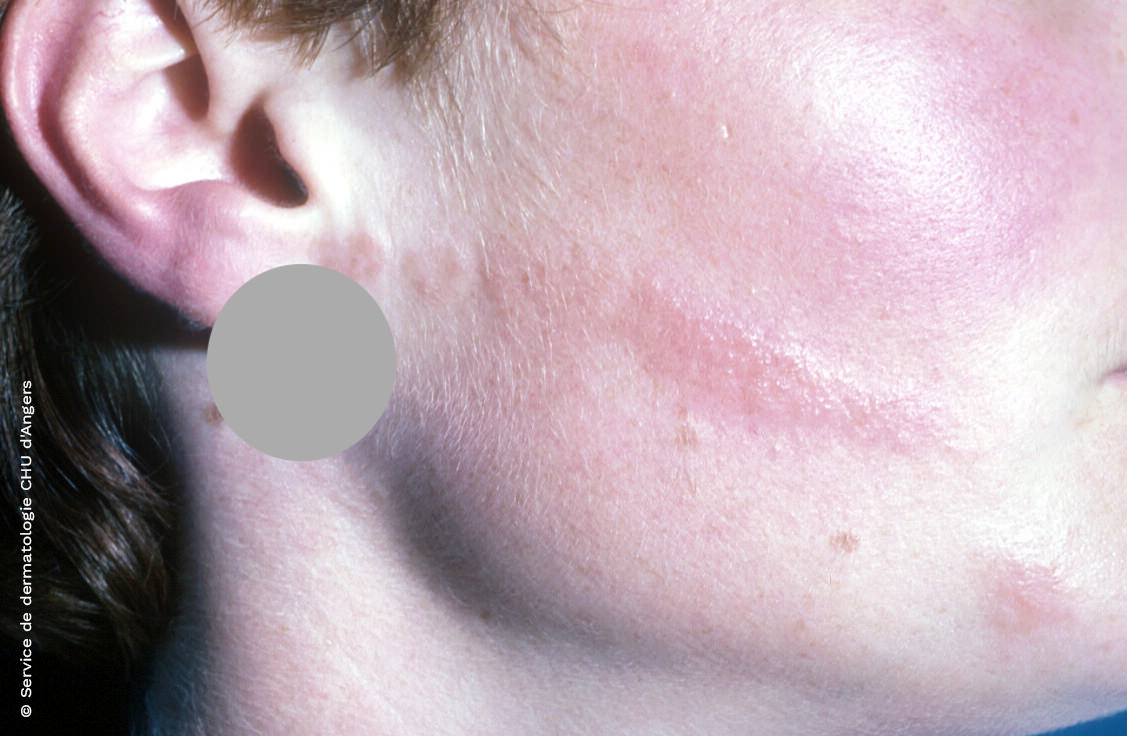 Eczema en la cara a través del contacto con las manos debido a un antibiótico