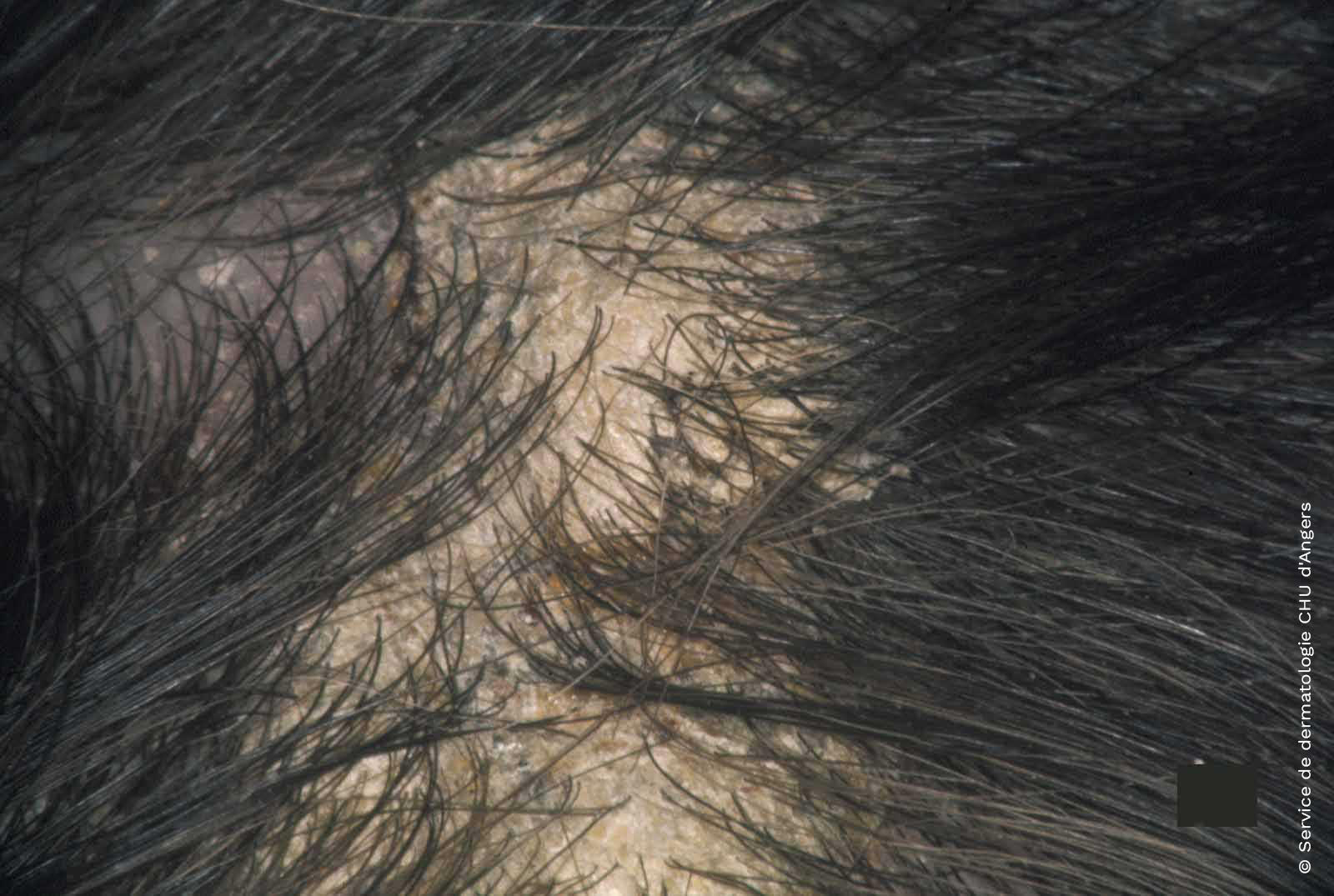 Psoriasis of the scalp