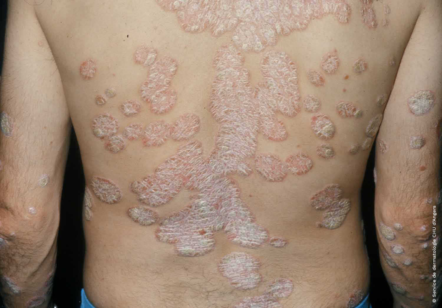 Plaque psoriasis of the back