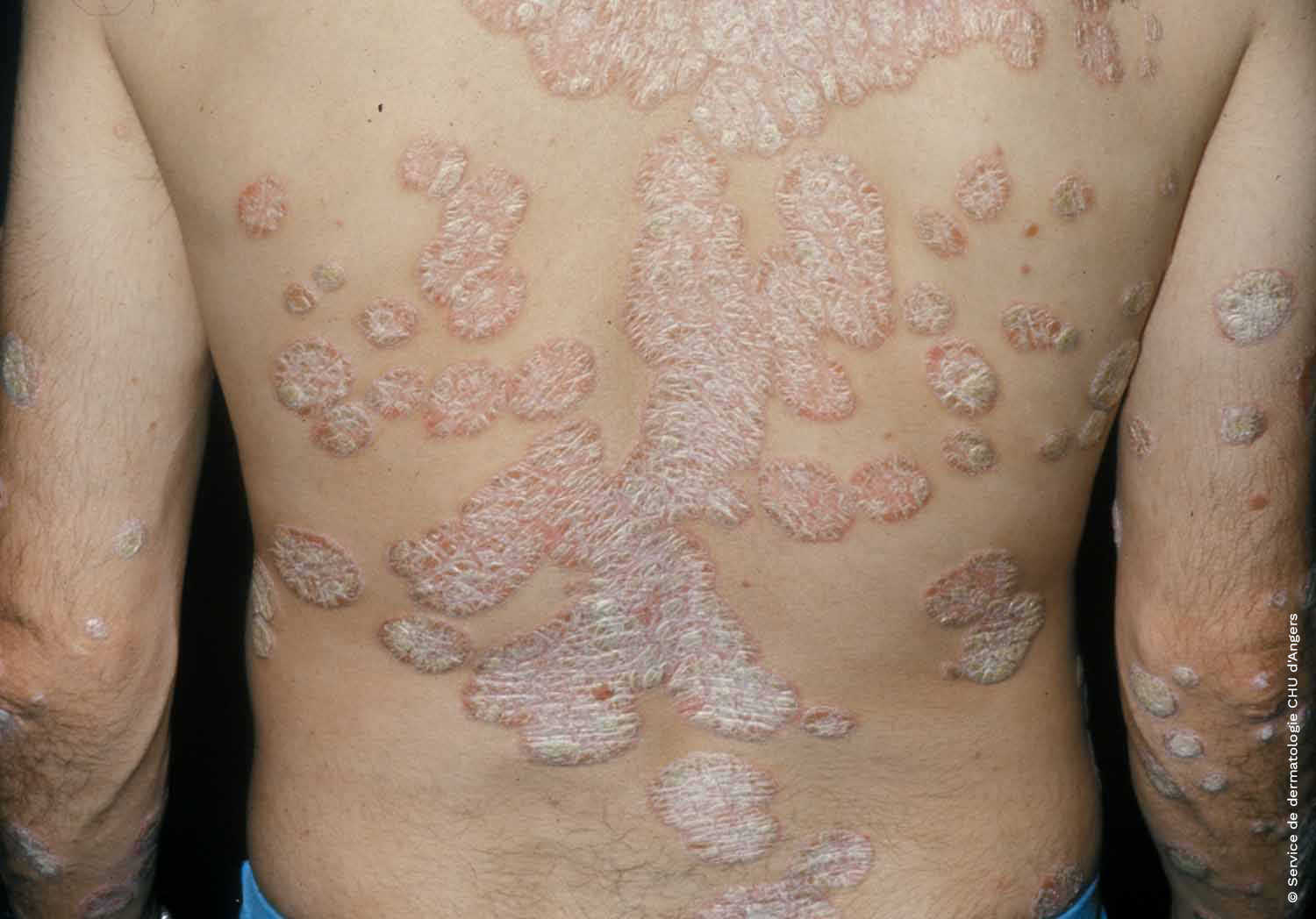 Psoriasis en placas de la espalda