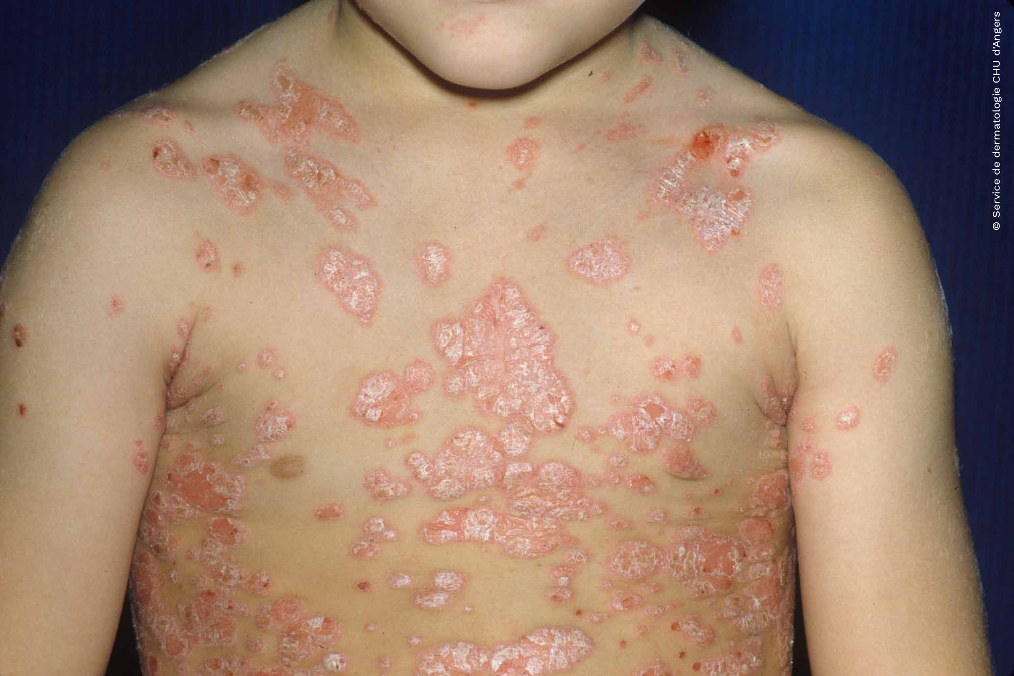 Psoriasis infantil del busto