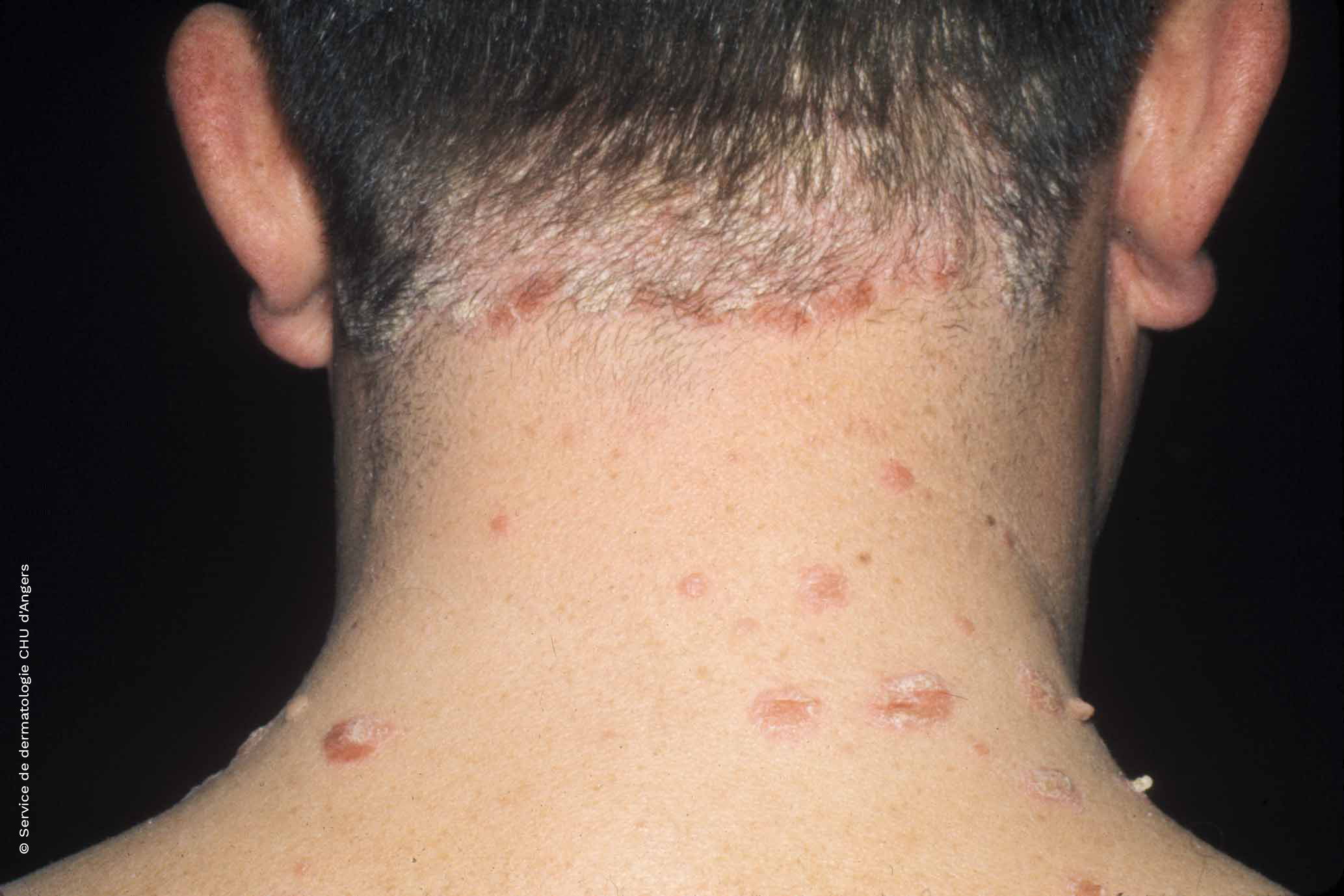 Psoriasis de la nuca