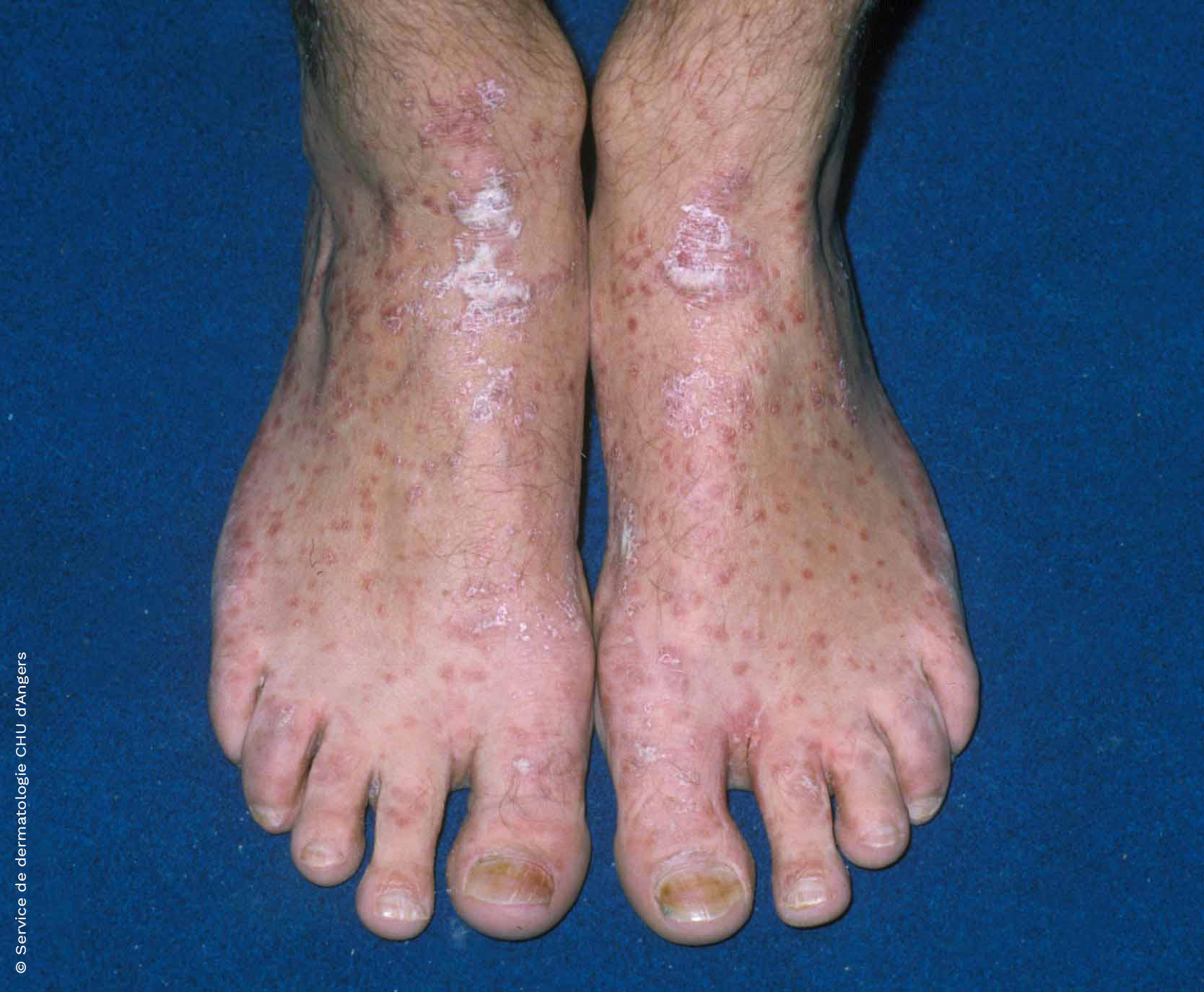 Psoriasis des pieds