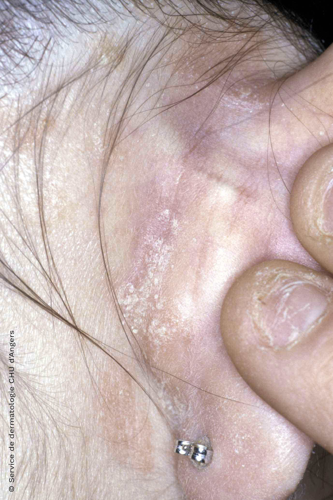 Psoriasis retroauricular discreta