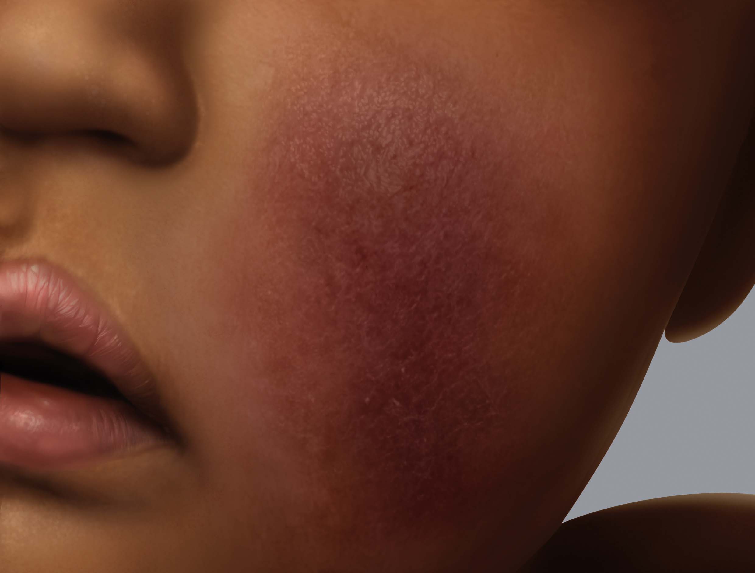Symptoms of eczema on darker skin: erythema