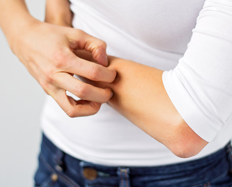Eczema: los trucos contra el rascado