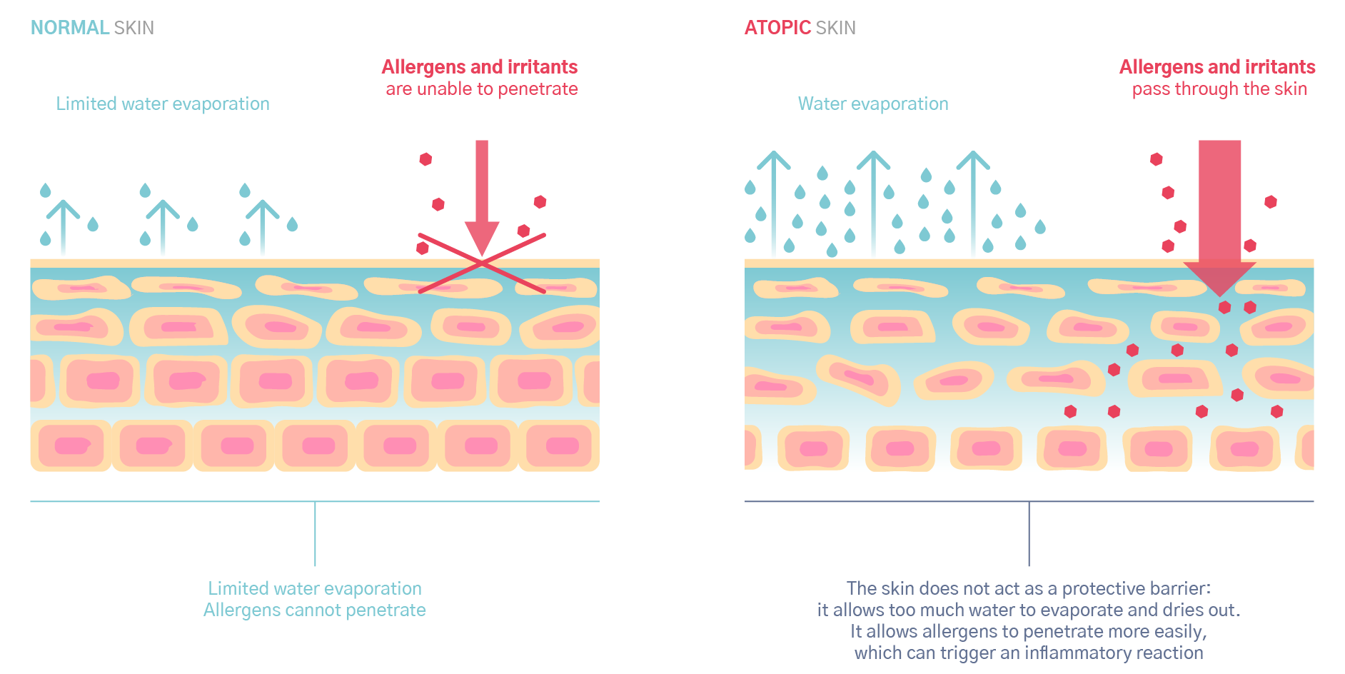 Atopic skin : skin barrier