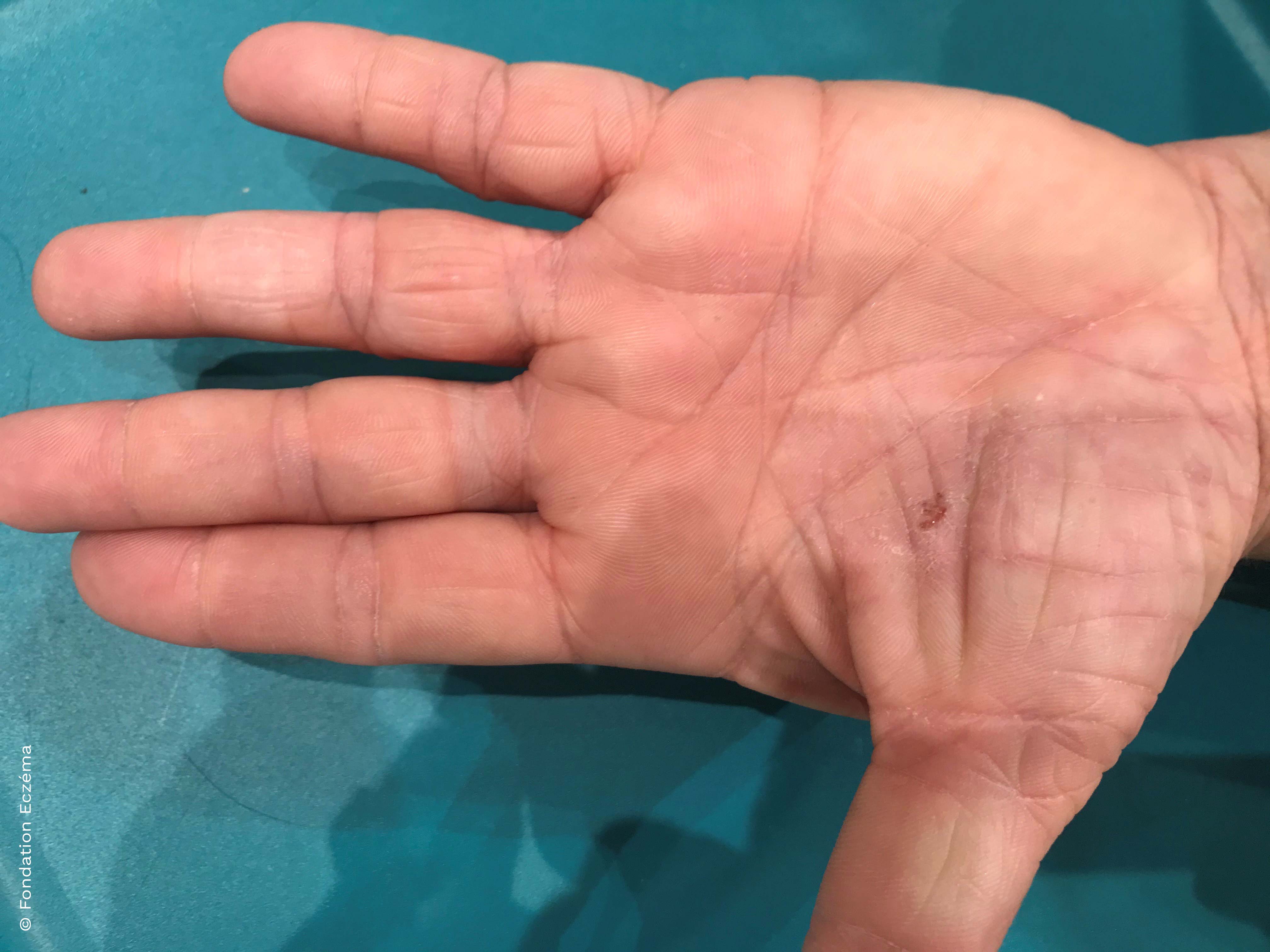Atopic dermatitis of the hand of a adult