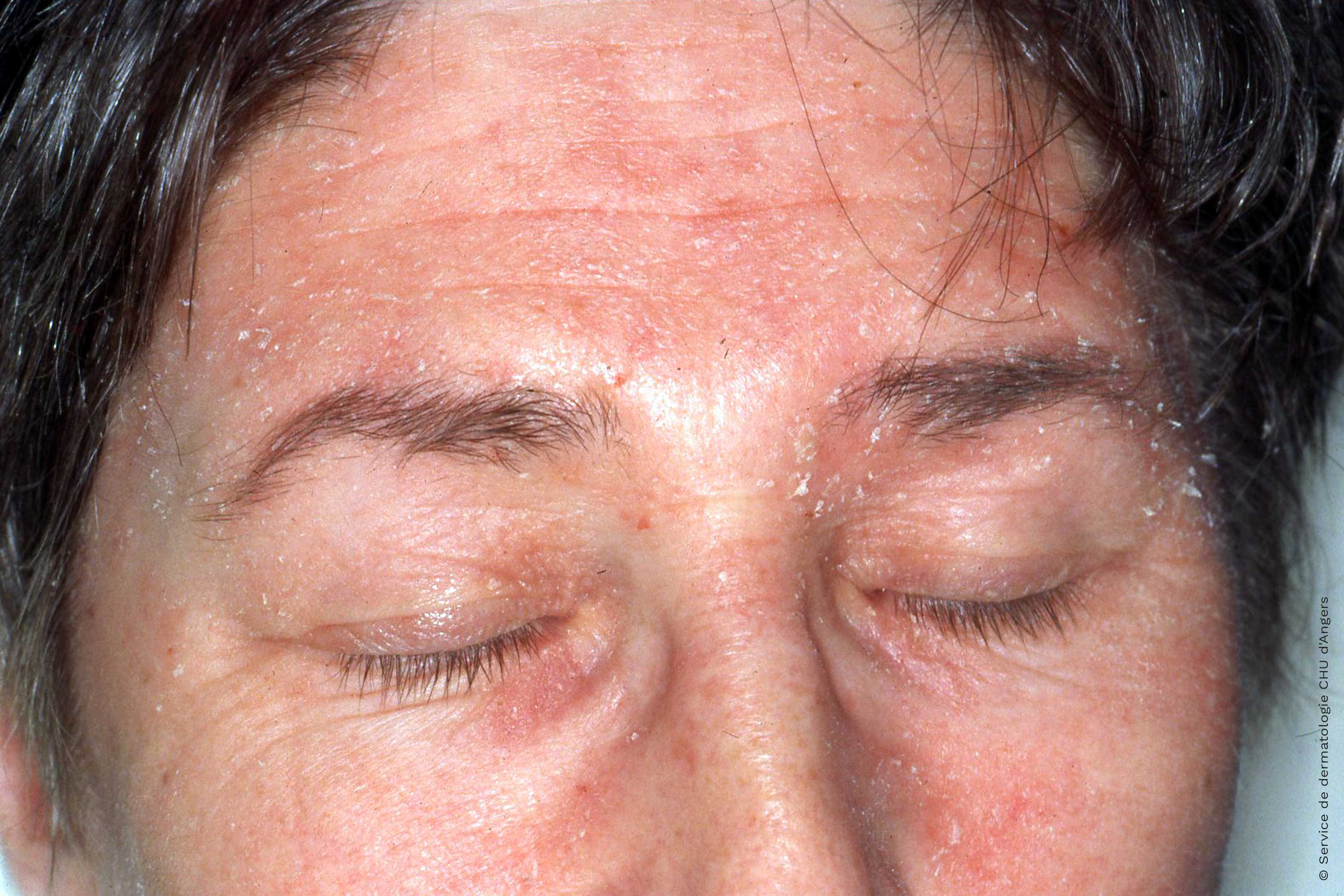 Seborrhoische Dermatitis