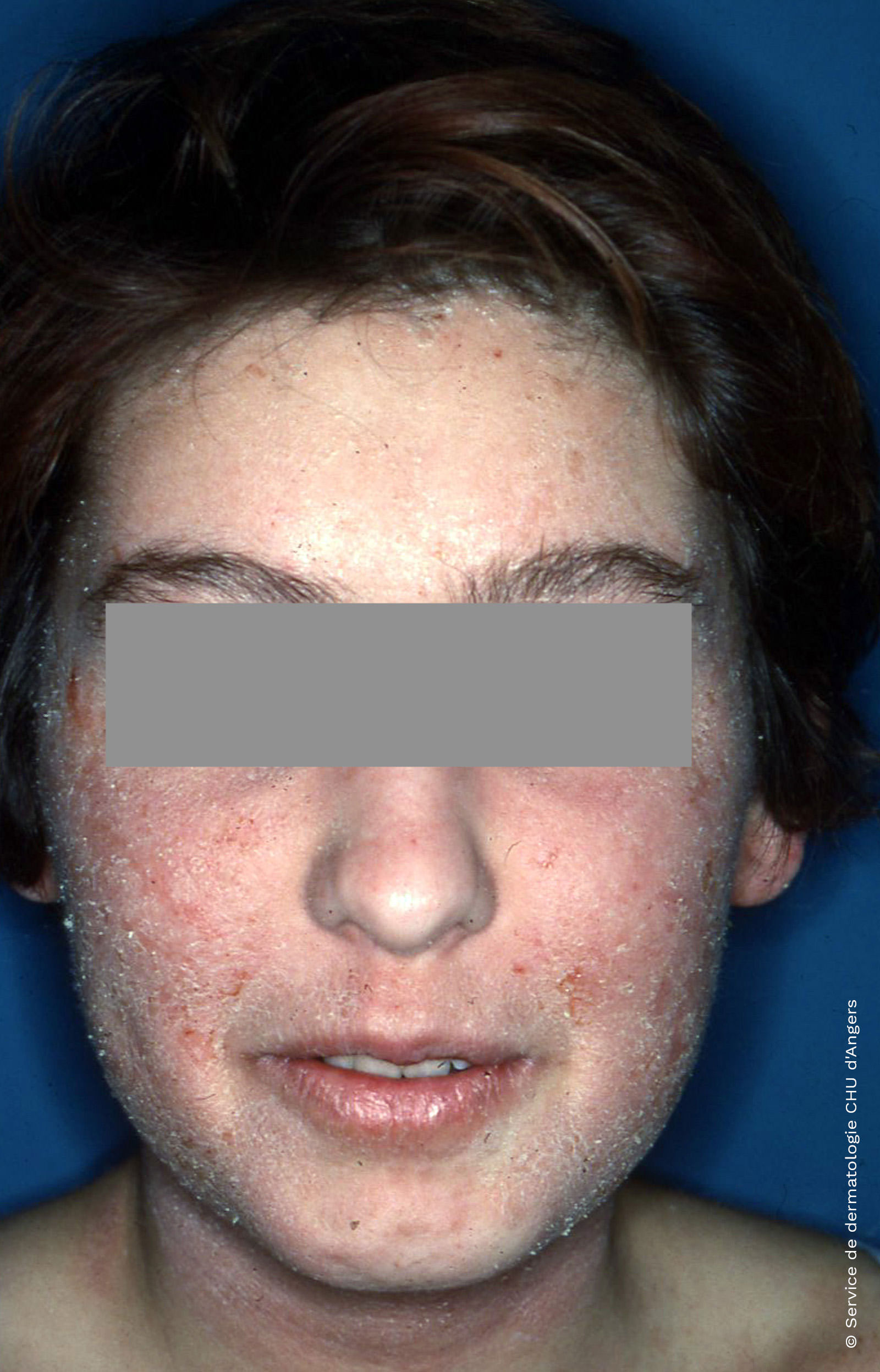 Eczema atópico en la cara de un adulto