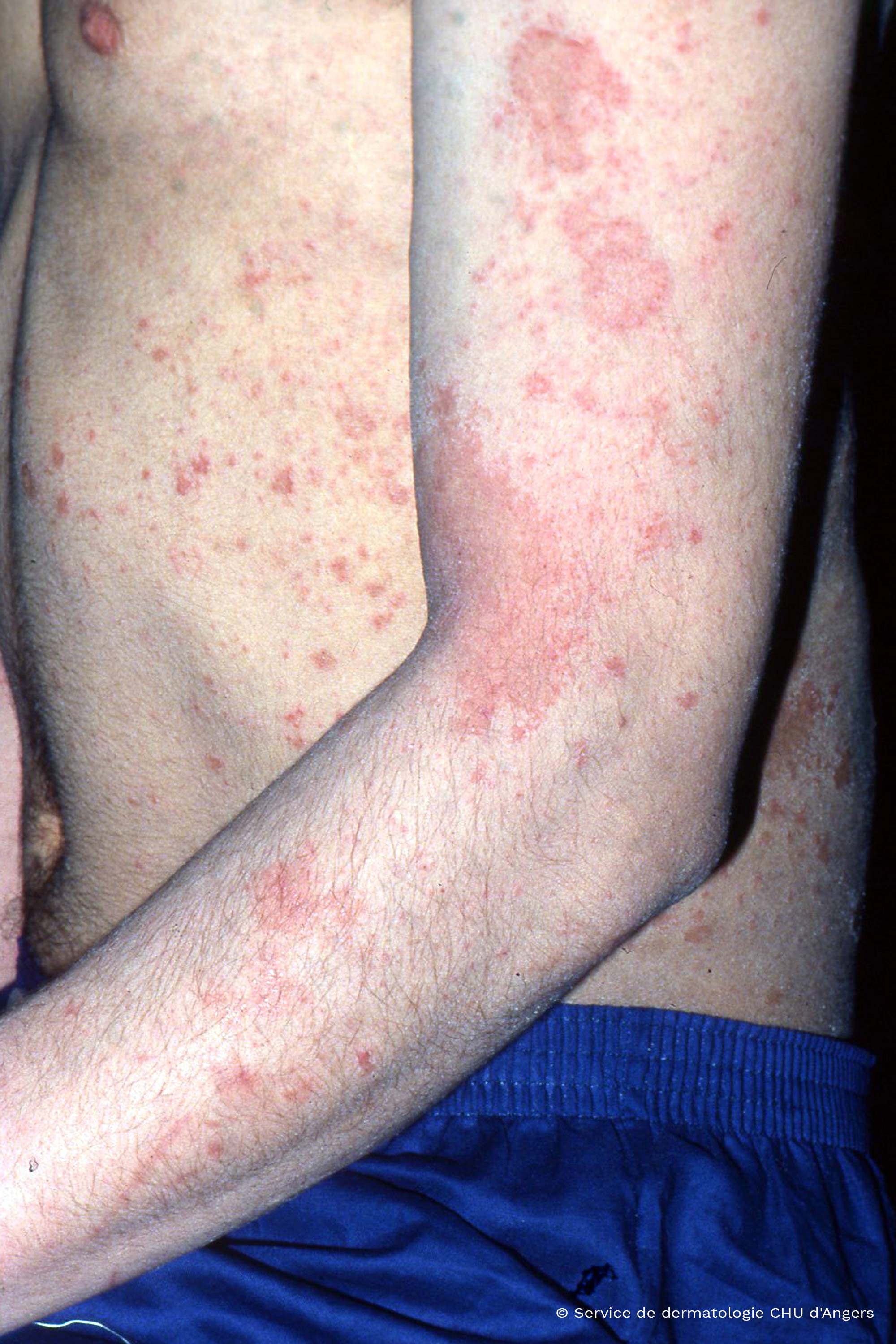 Eczema atópico en el brazo de un adulto