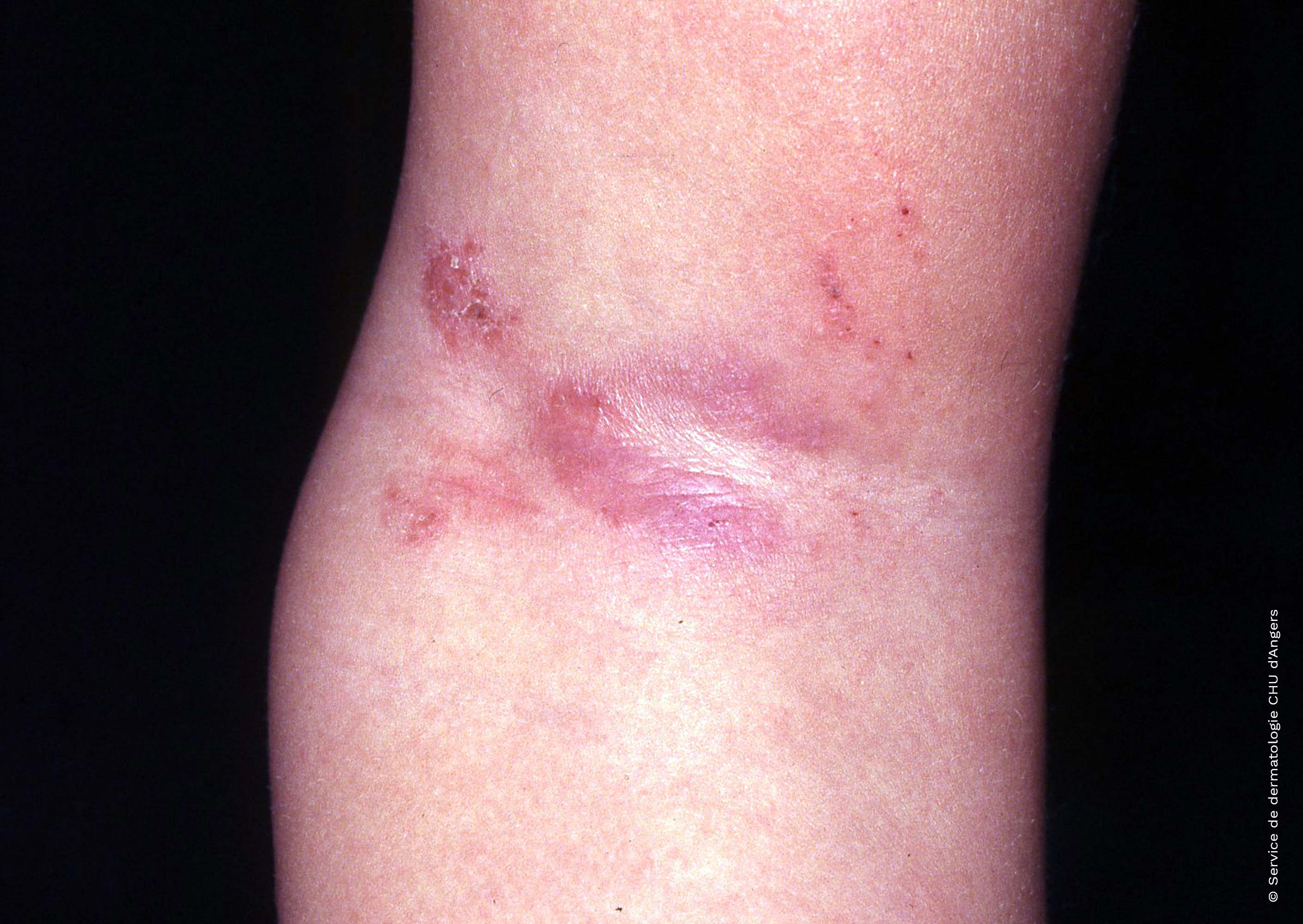 Eczema atópico en el pliegue del codo de un adulto