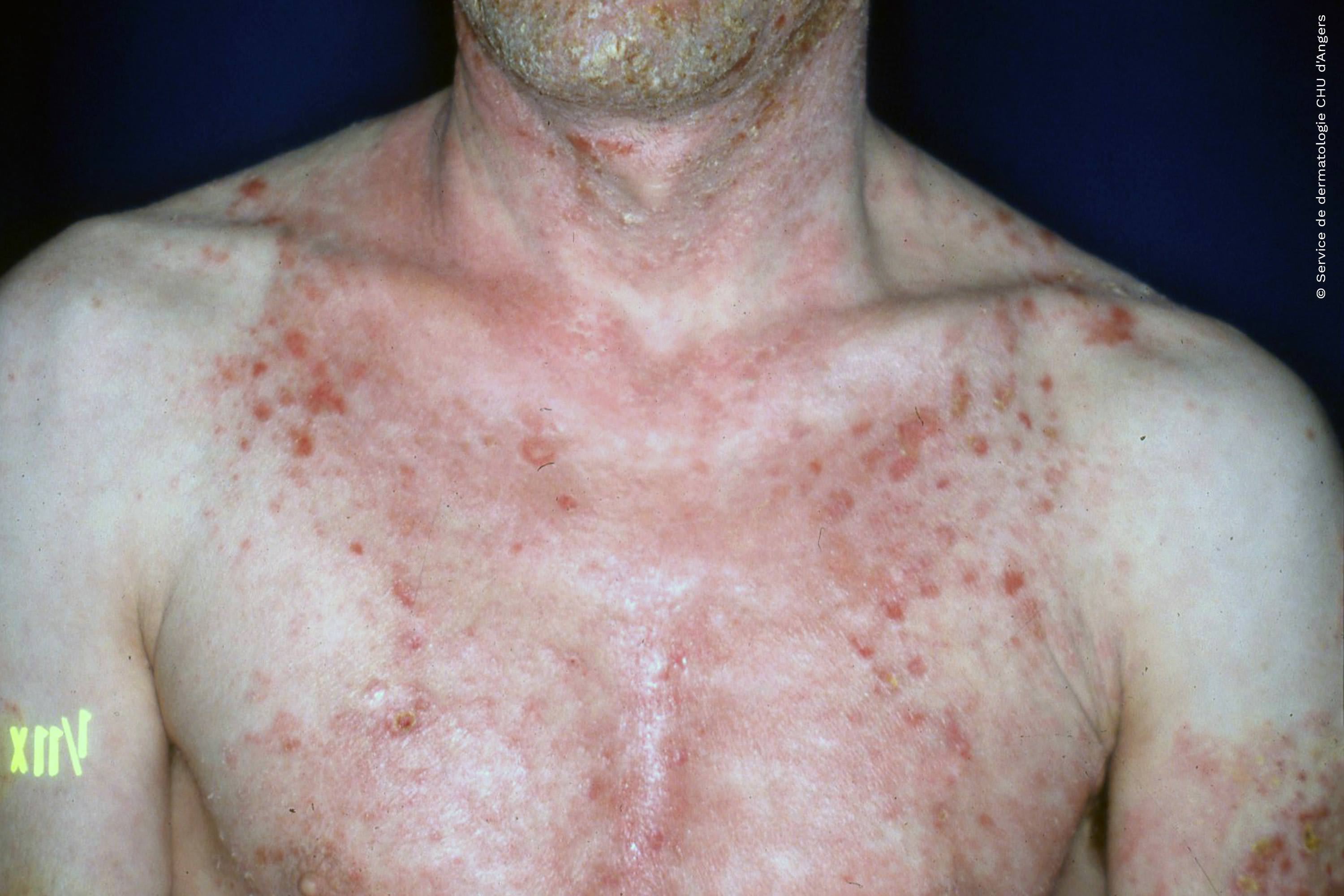 Eczema atópico en el tórax de un adulto