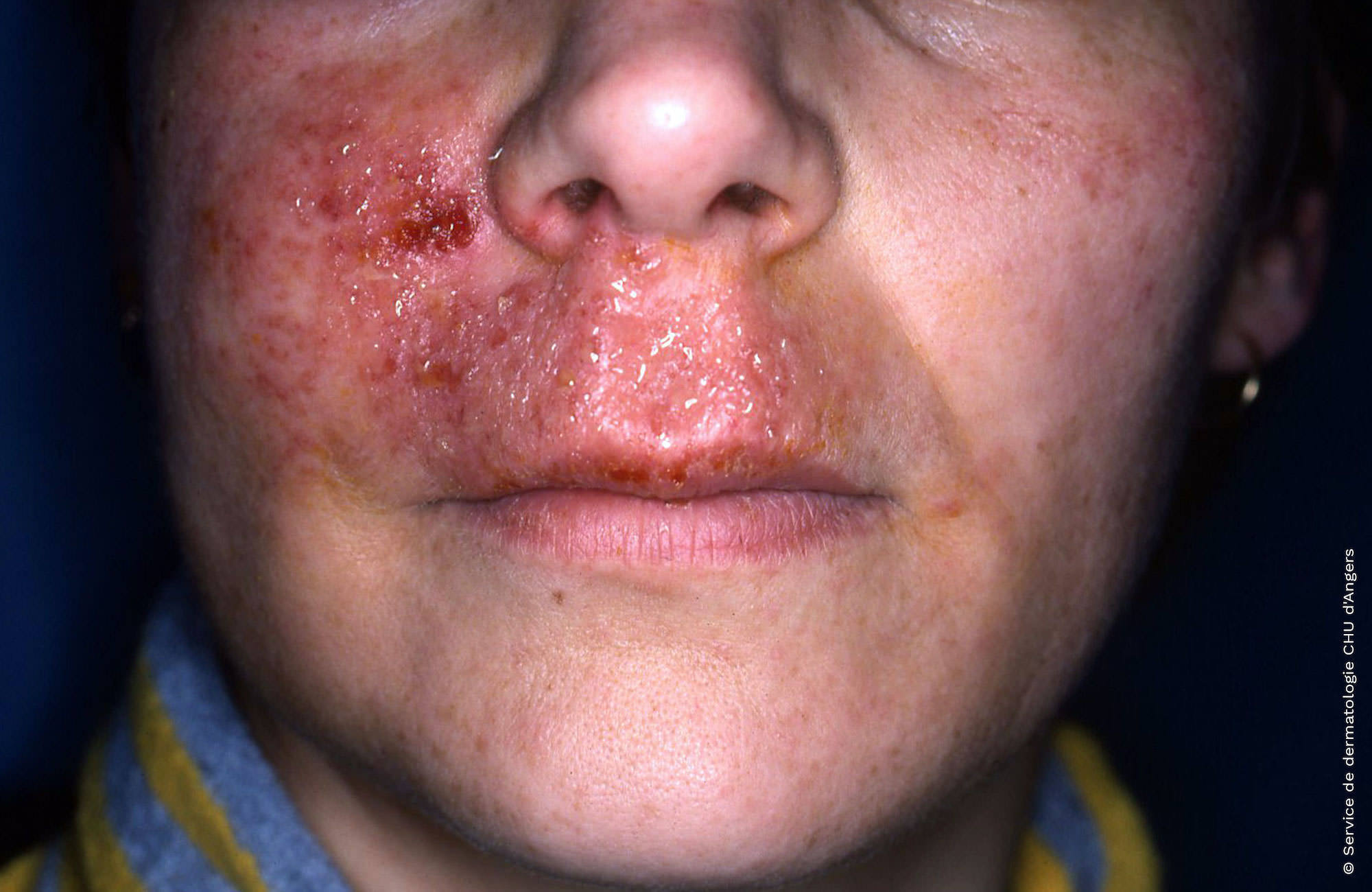 Allergisches Kontaktekzem im Gesicht und an den Lippen gegen ein Antiseptikum