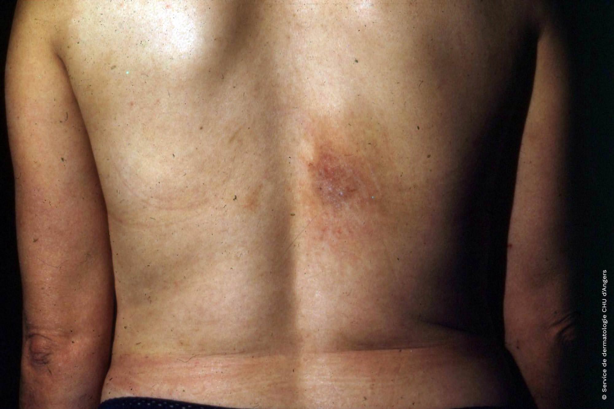 Eczema de contacto alérgico debido al níquel en la hebilla del sujetador