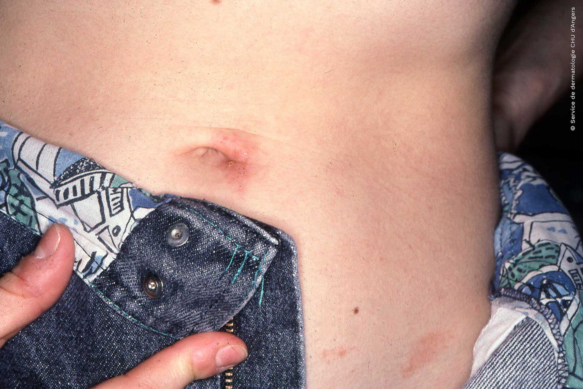 Eczema de contato alérgico ao níquel do botão das calças de ganga