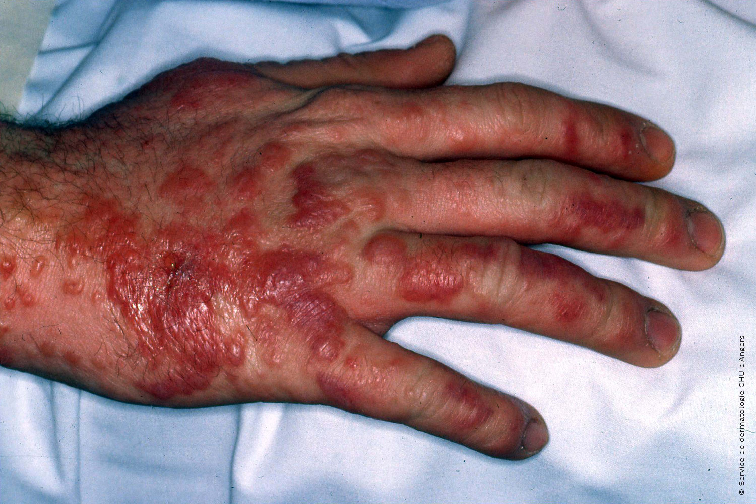 Blasenförmiges allergisches Kontaktekzem an der Hand durch Primel