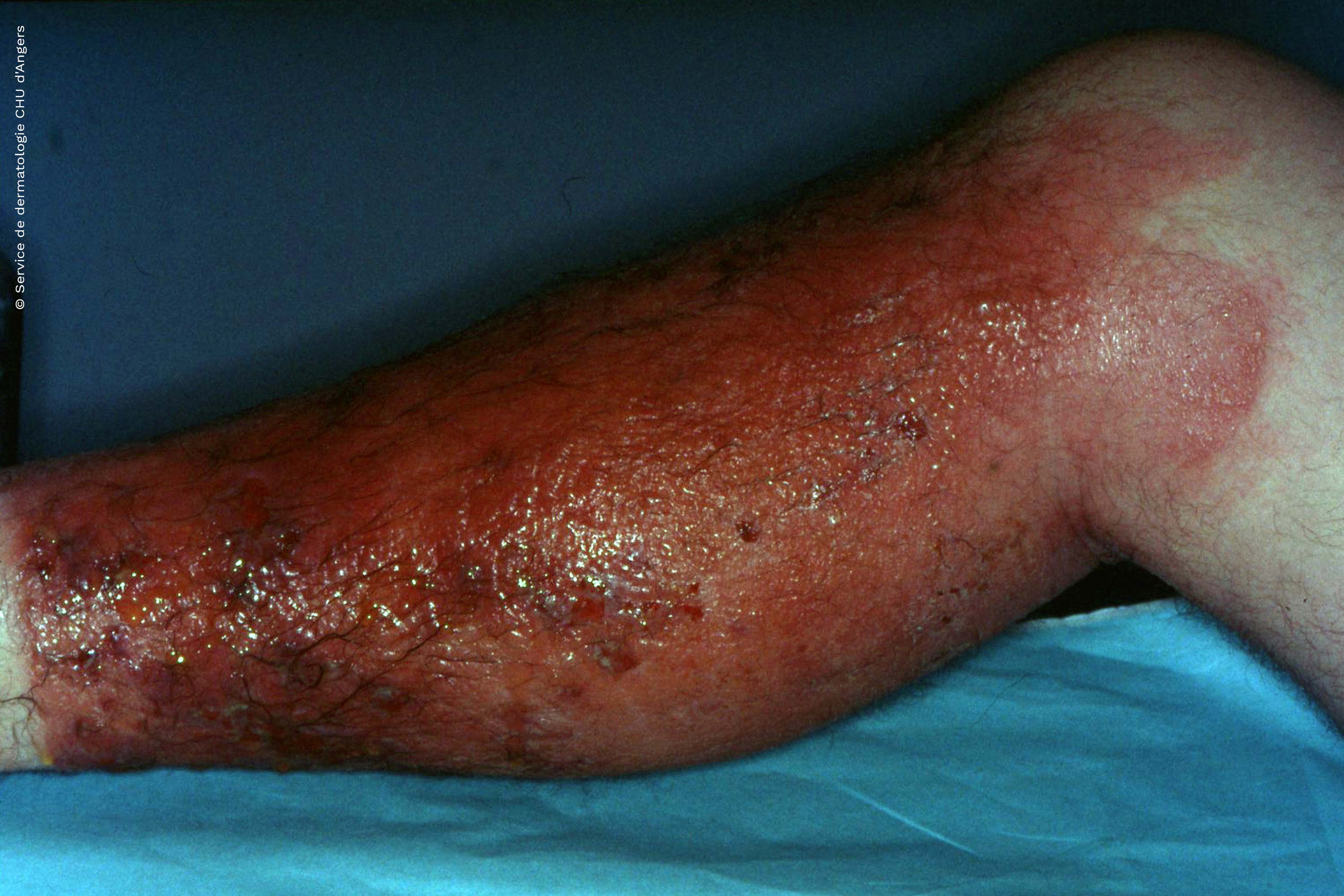 Eczema de contacto fotoalérgico en la pierna debido al ketoprofeno