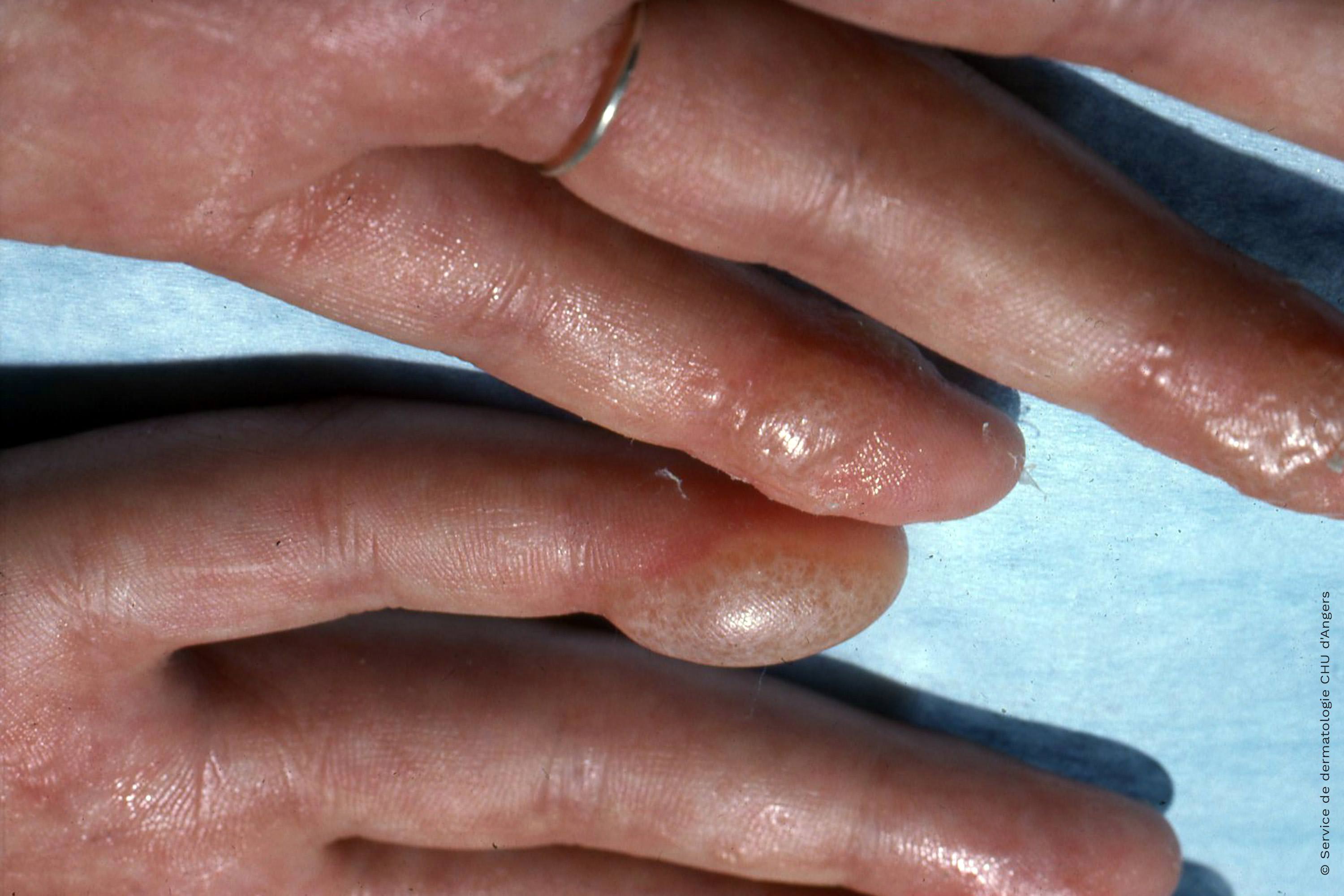 Eczema dishidrótico de las manos