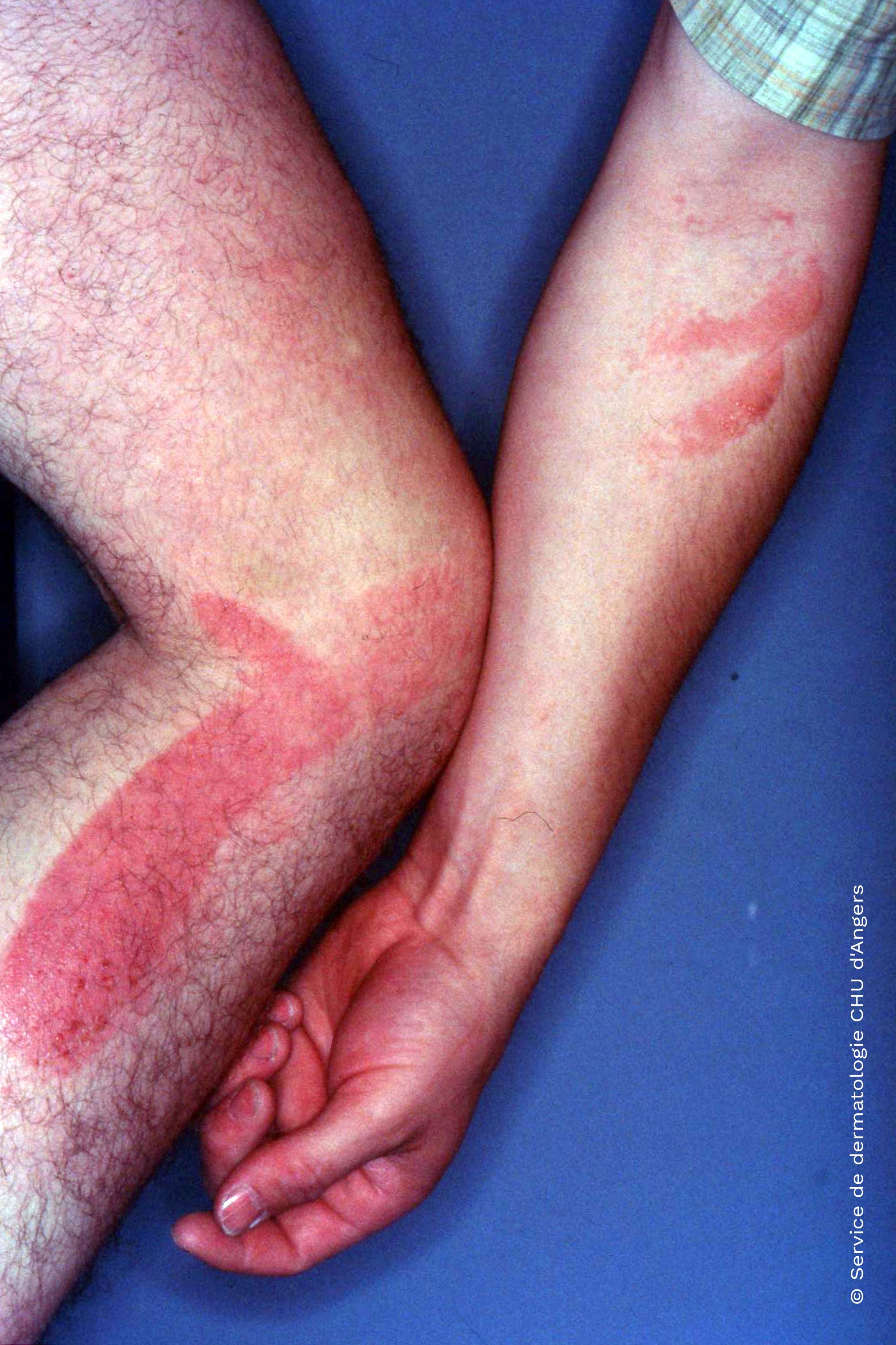 Eczema - trasmissione attraverso le mani - da ketoprofene
