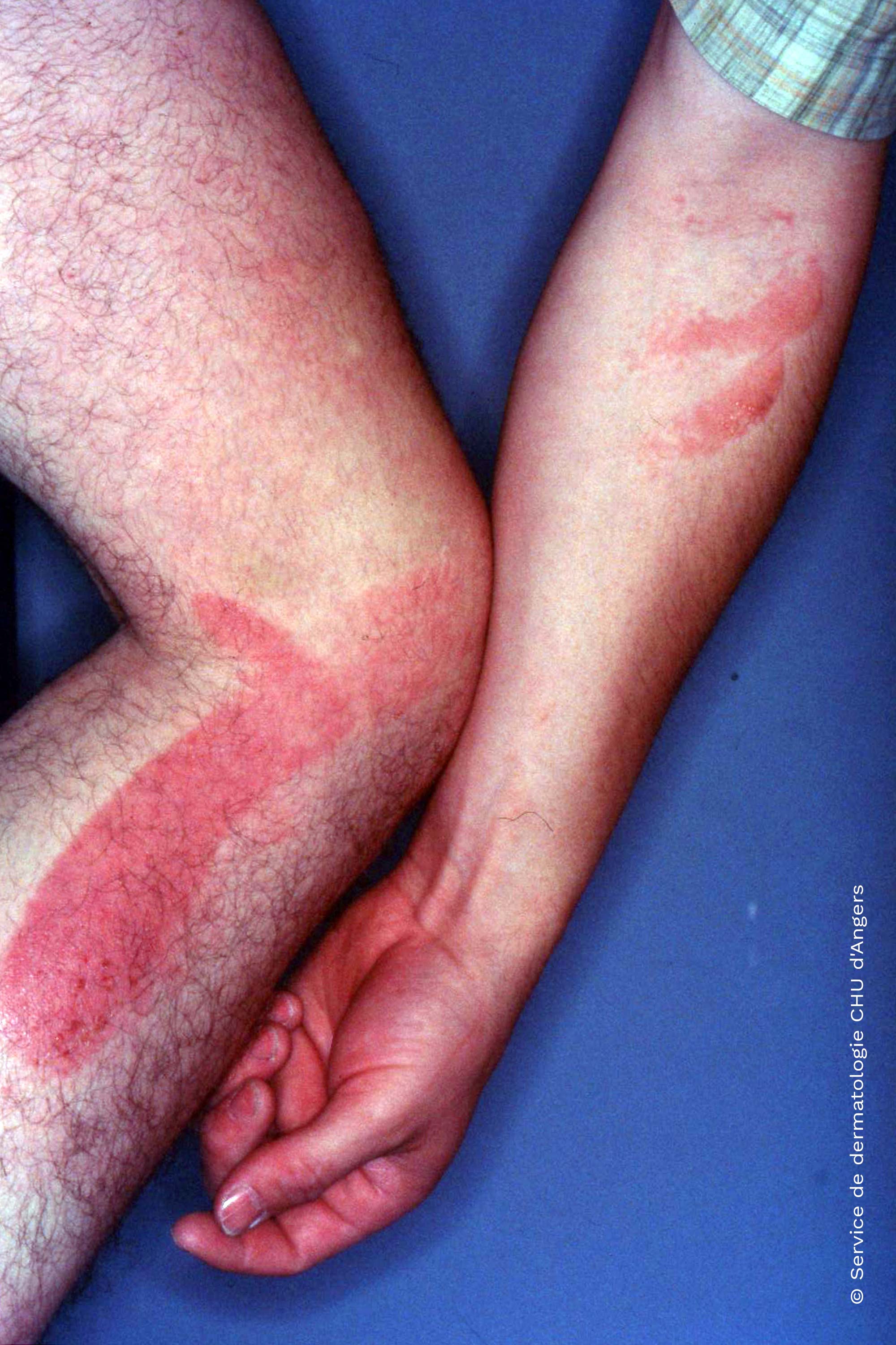 Eczéma des jambes | Fondation Eczéma