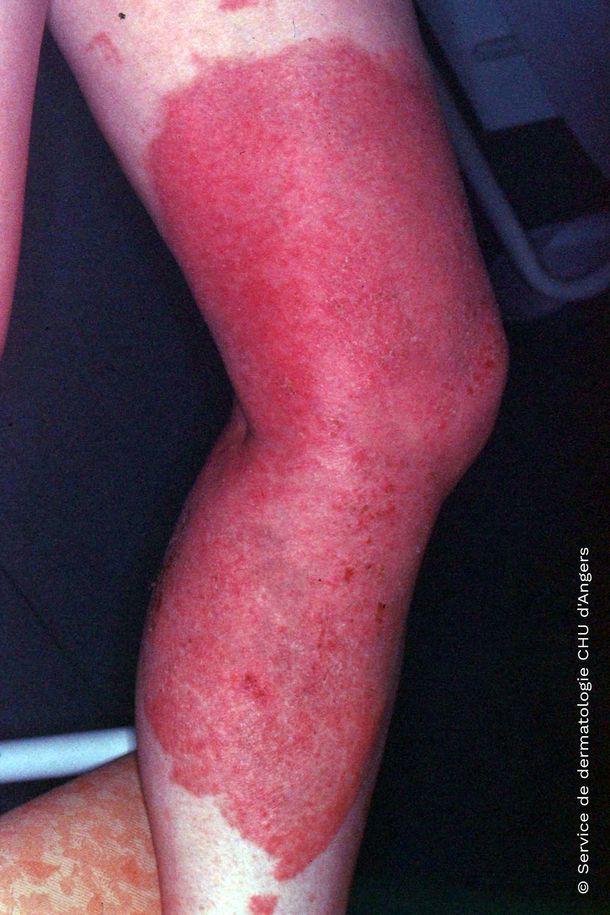 Eczema de contacto fotoalérgico debido al ketoprofeno