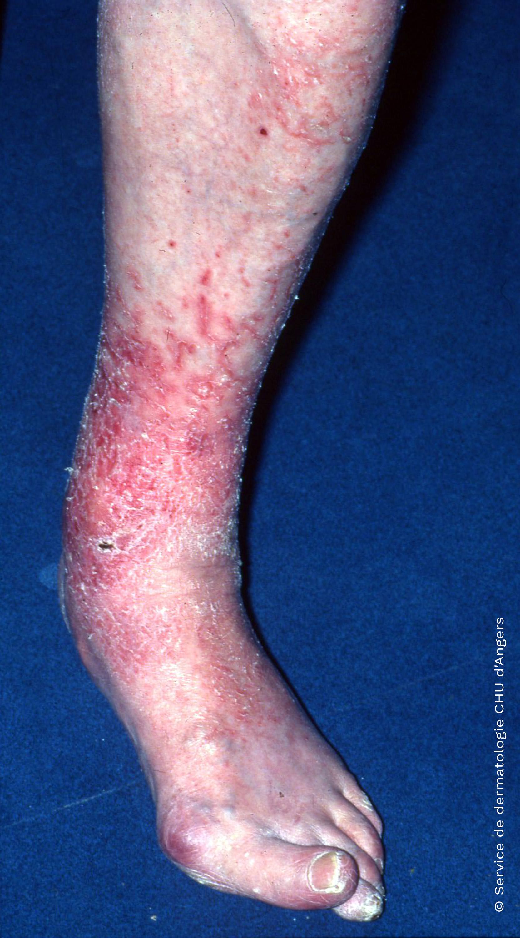 Eczema varicoso