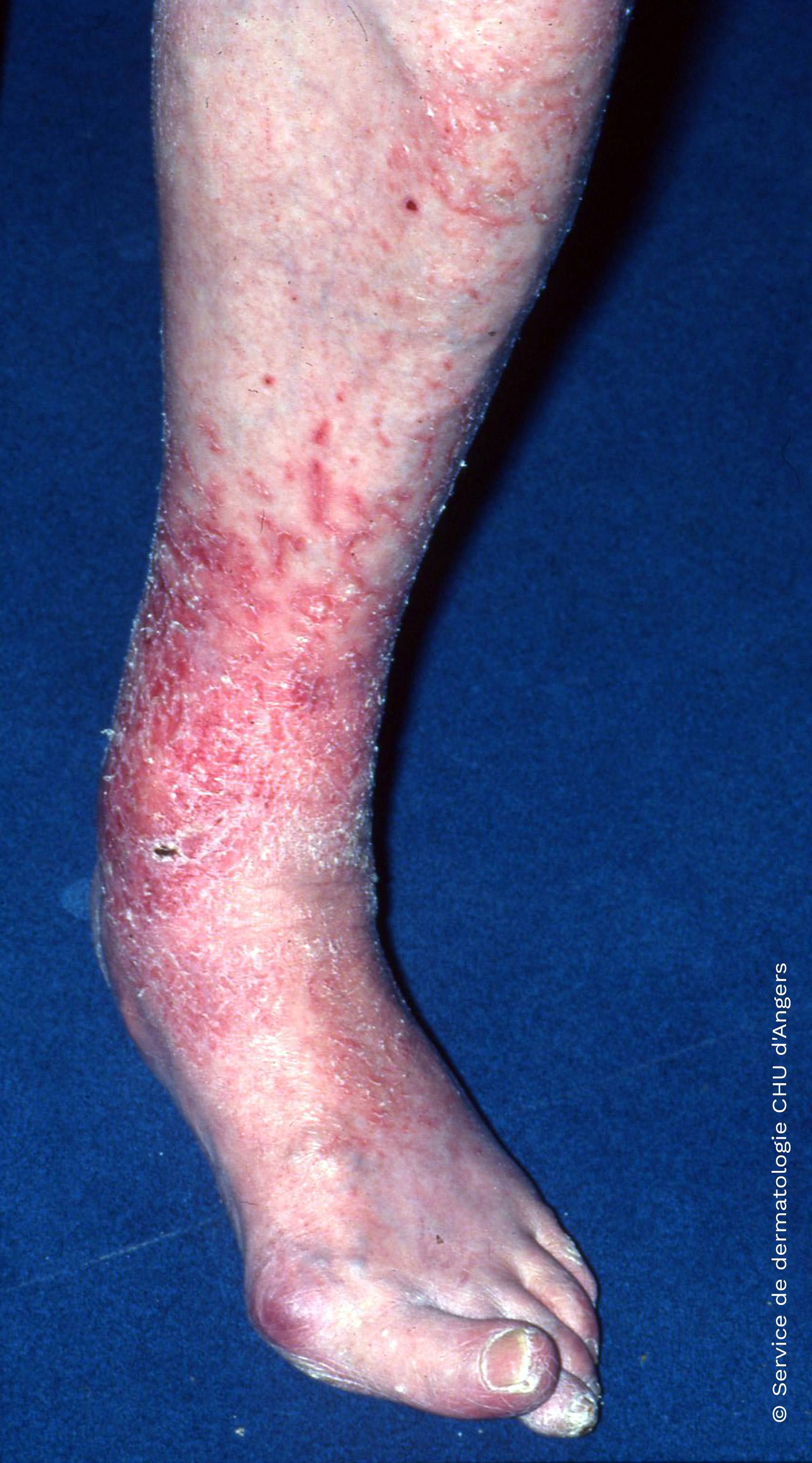 Varicose eczema