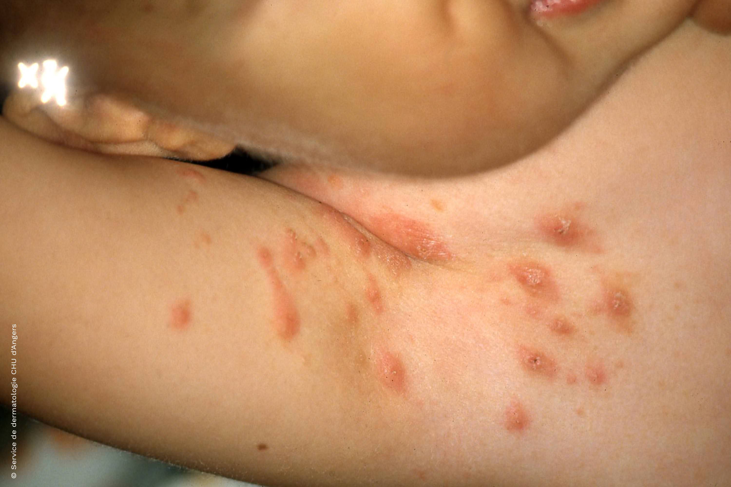 Scabies: scabious nodules of the infant