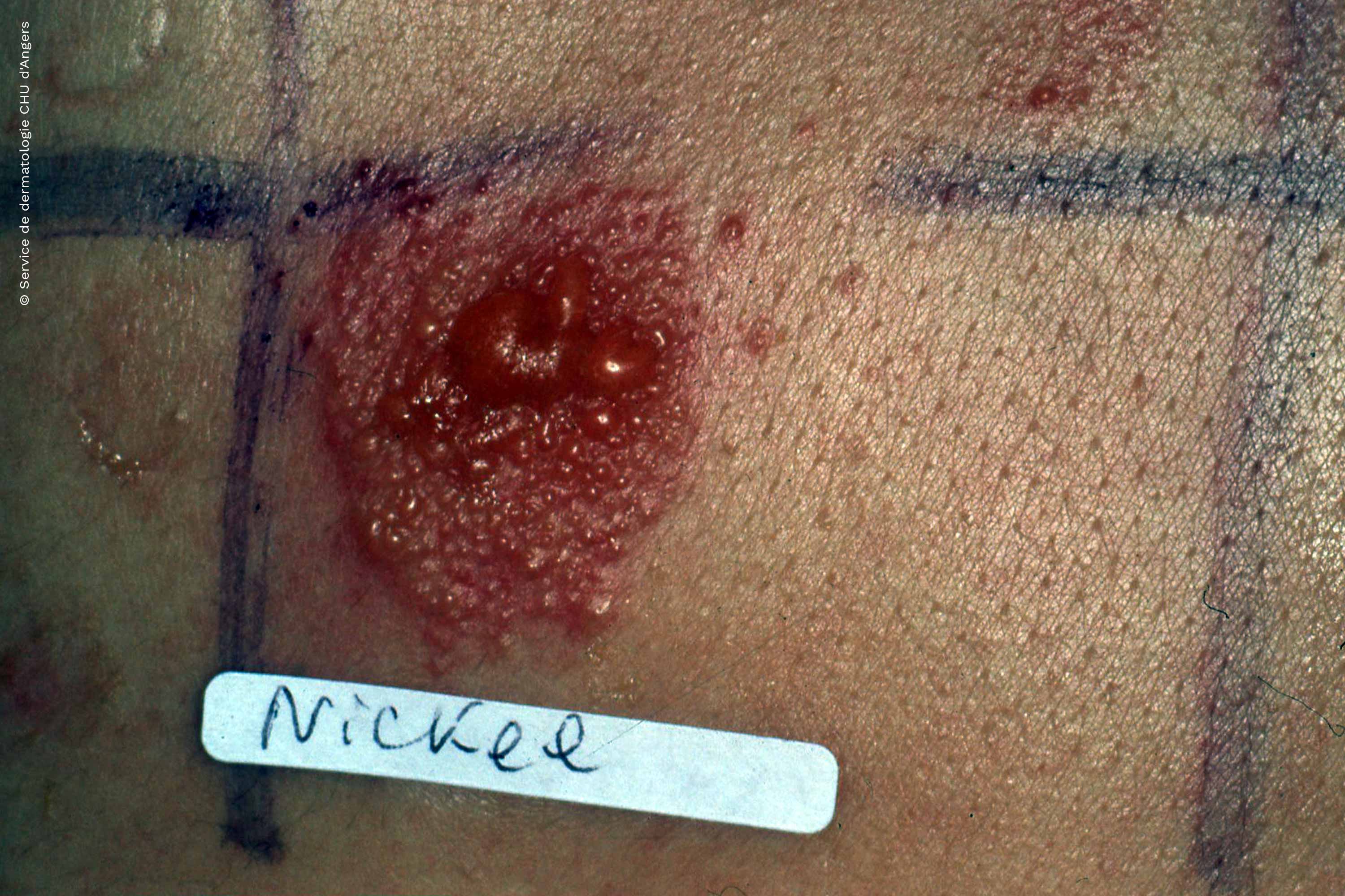 Highly positive nickel patch test