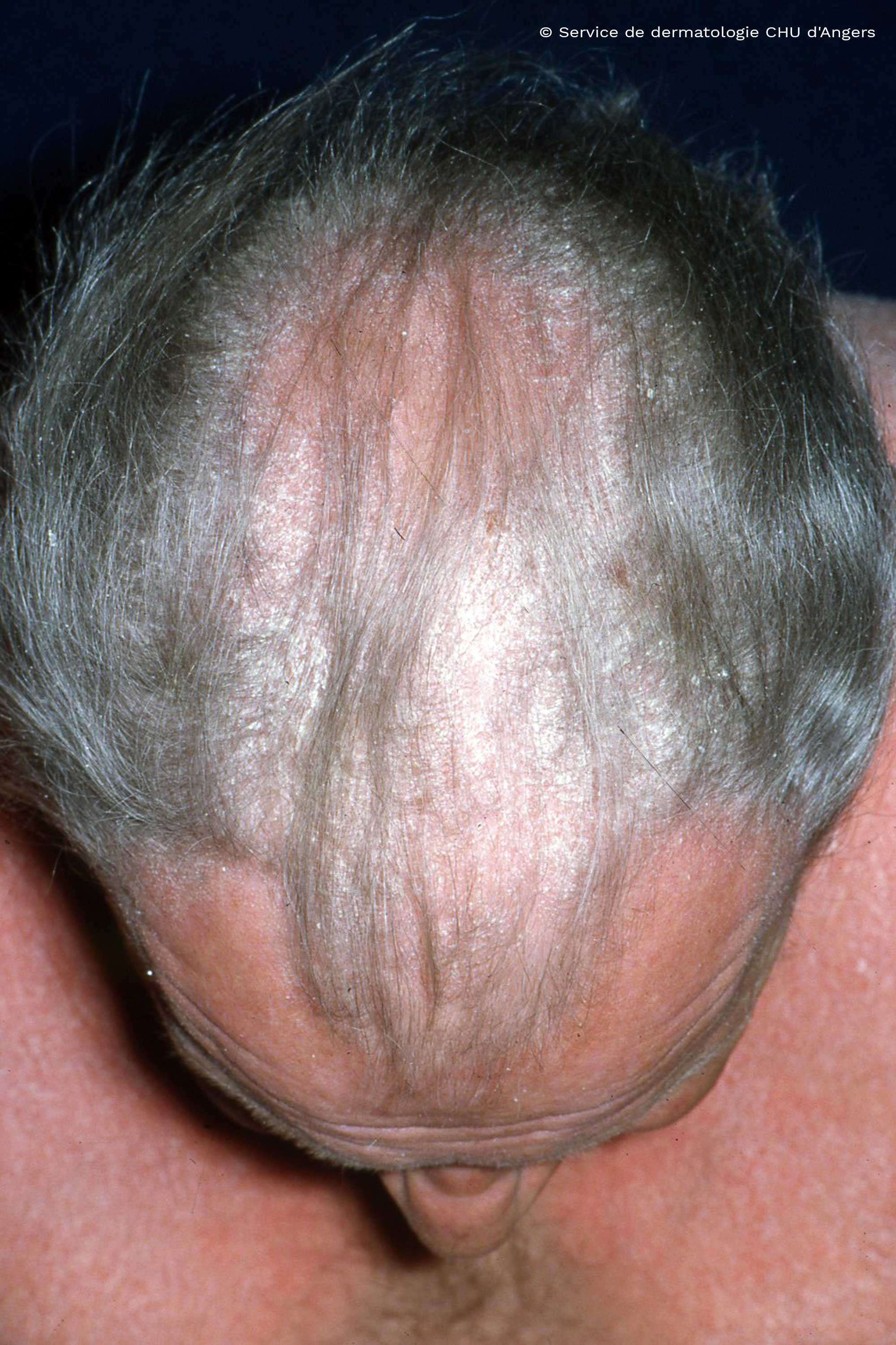 Psoriasis der Kopfhaut