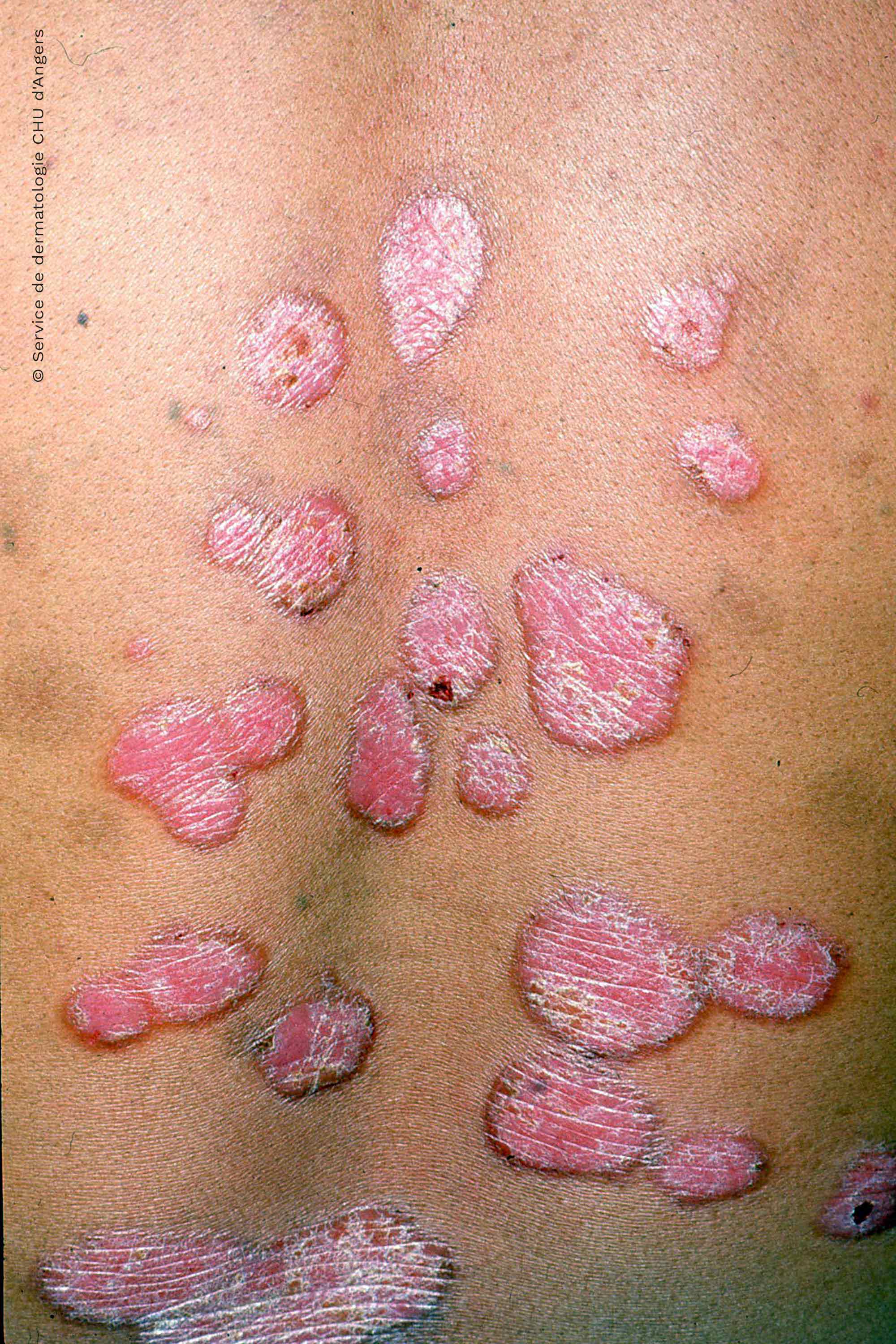 Psoriasis en placas