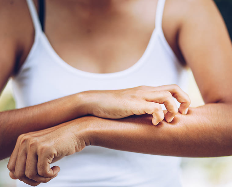 Treatments for eczema