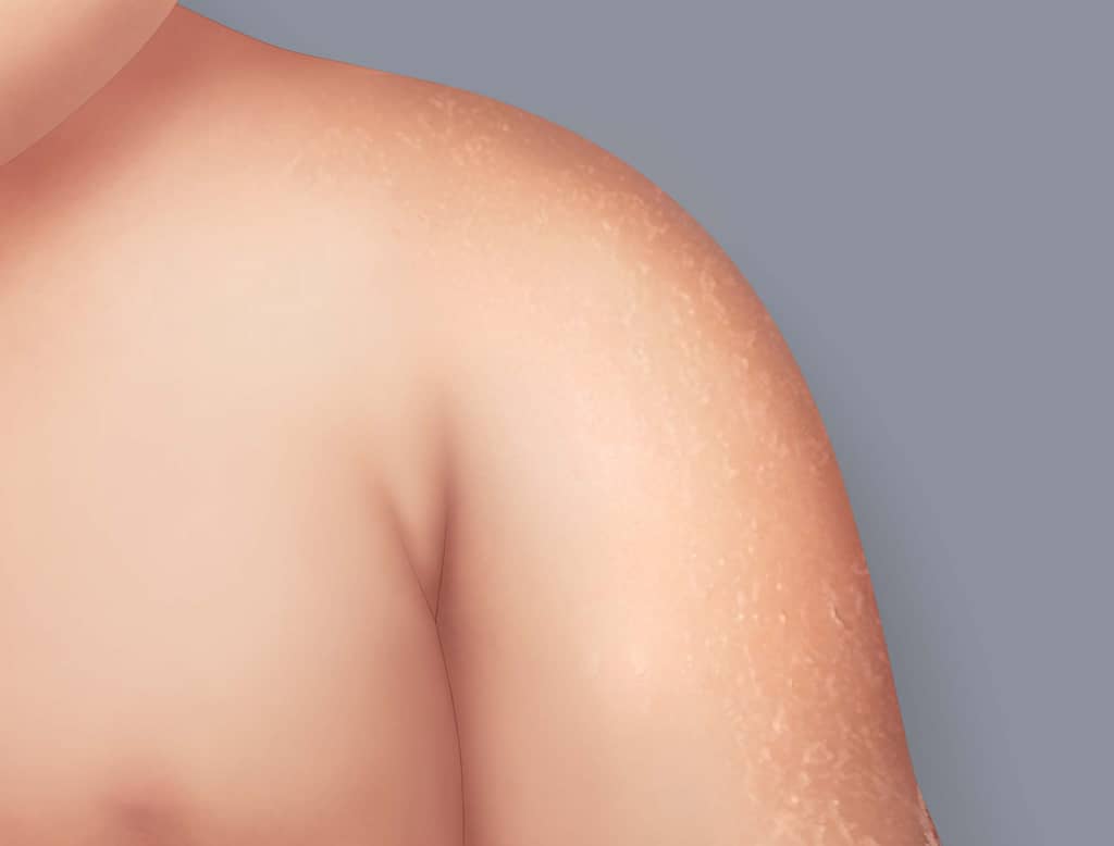 Síntomas del eczema atópico: piel seca, también denominada xerosis