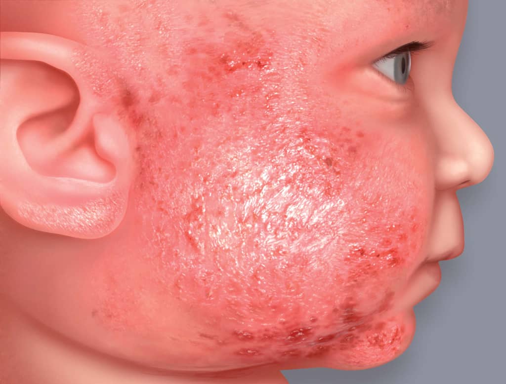Síntomas del eczema atópico: supuración