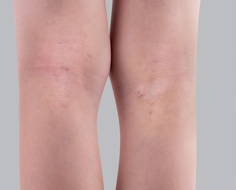 Does eczema leave scars?