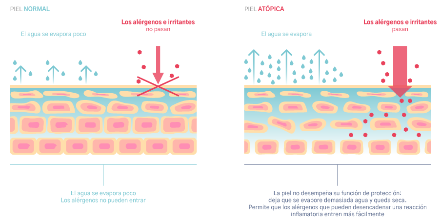 PIEL ATÓPICA