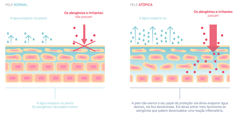  pele atópica