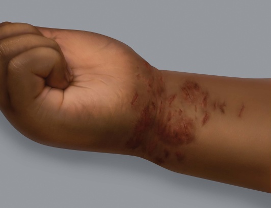 Symptômes de l'eczéma sur une peau foncée : marques de grattage (excoriations)