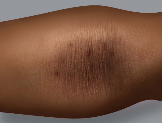 Symptômes de l'eczéma sur une peau foncée : épaississement de la peau (lichénification)