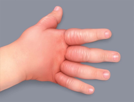 Symptômes de l'eczéma atopique : gonflement  ou œdème