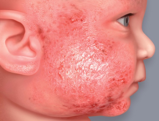 Symptômes de l'eczéma atopique : suintements (vésicules - croûtes)