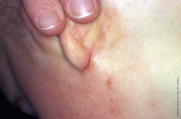 What Causes Eczema On The Ears What Causes Eczema On The Ears
