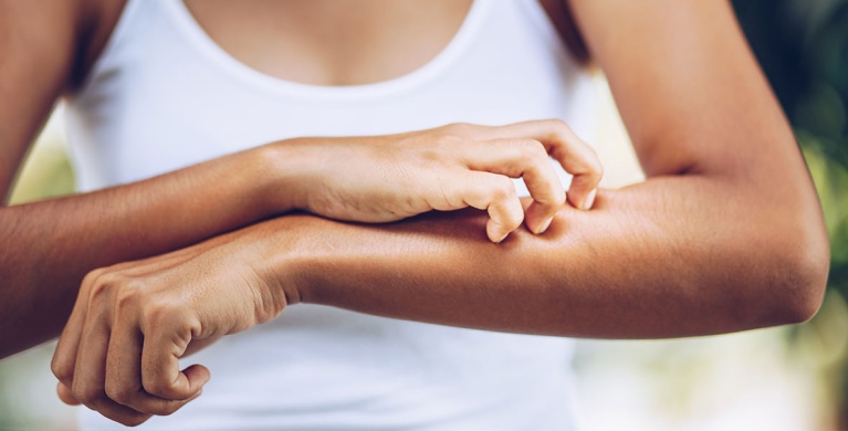 List of the different types of eczema